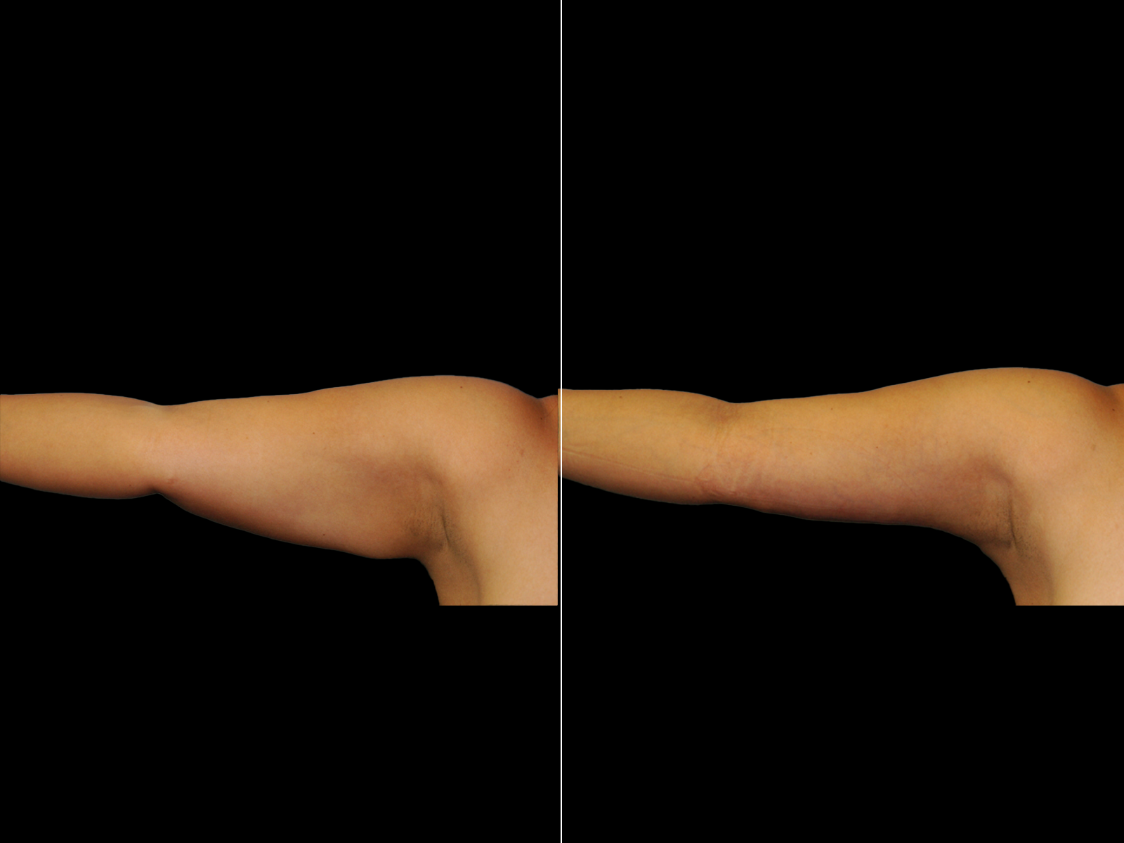 This patient underwent a standard brachioplasty.