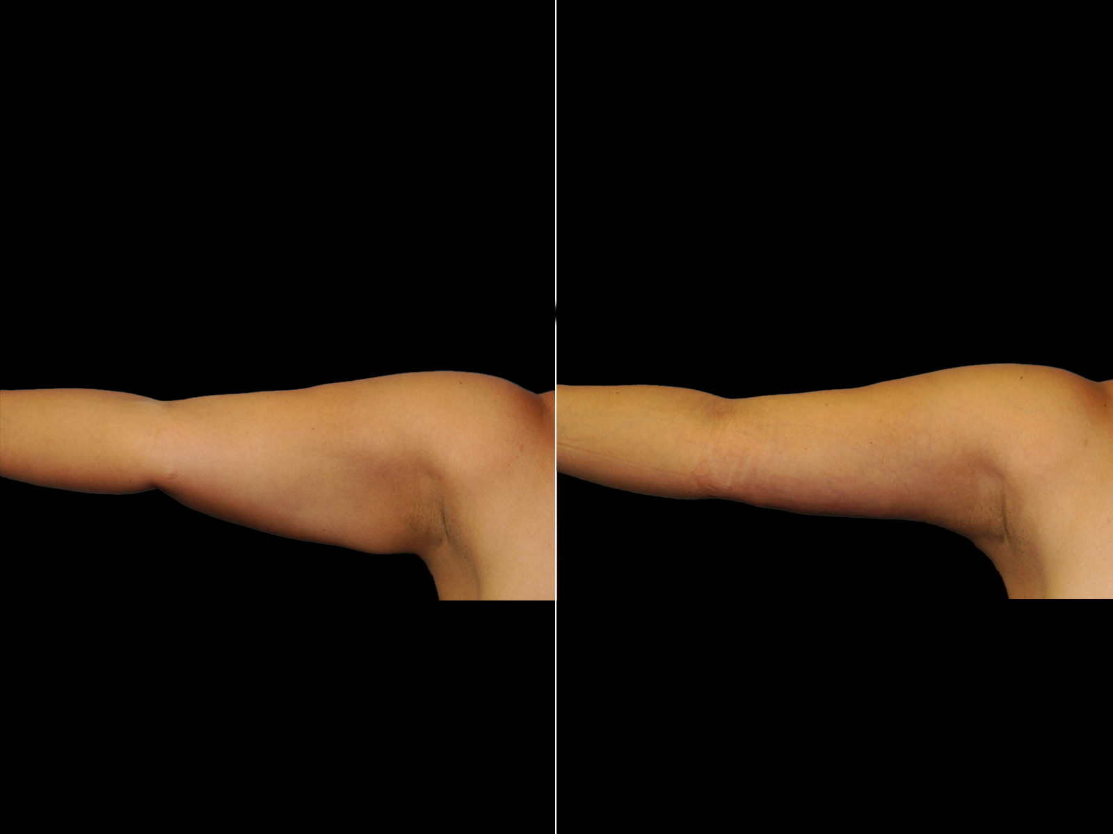 This patient underwent a standard brachioplasty.