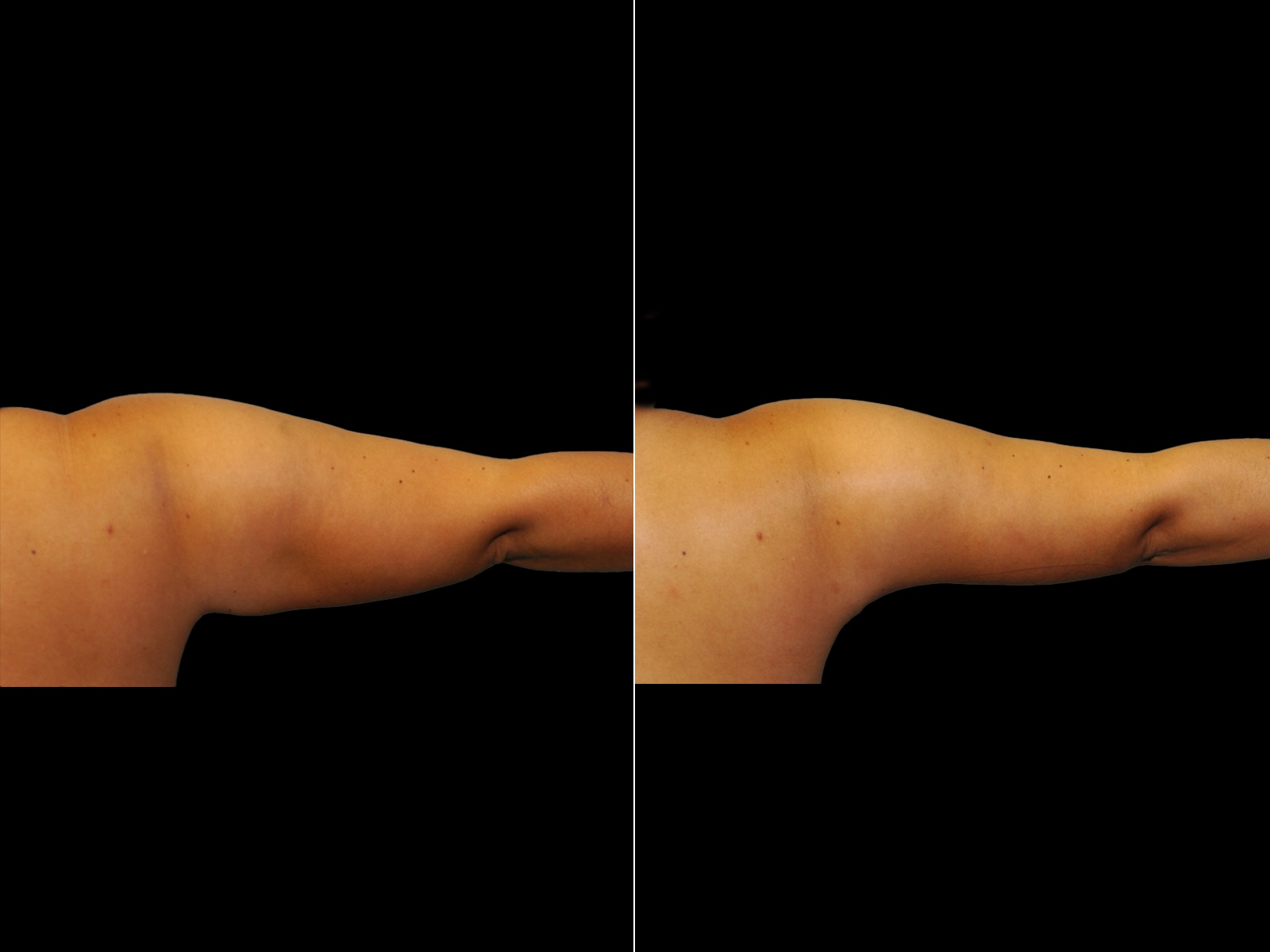 This patient underwent a standard brachioplasty.