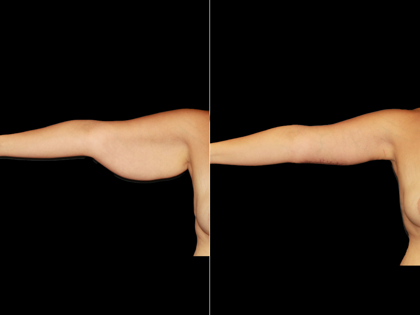 This patient underwent an extended brachioplasty.