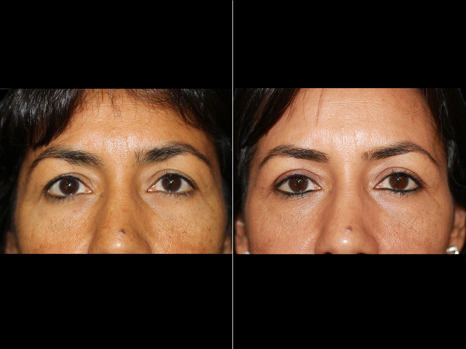This patient underwent an upper blepharoplasty with fat transfer to the tear trough.