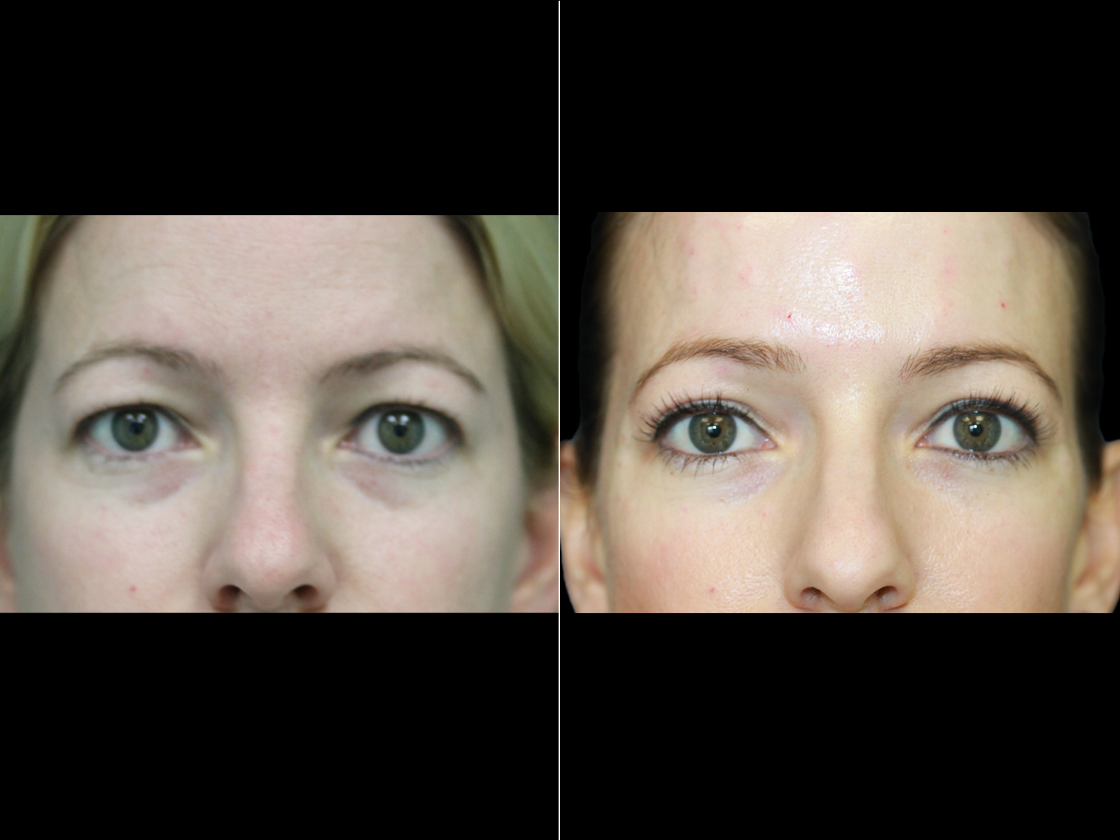 This patient underwent an upper blepharoplasty and botox.