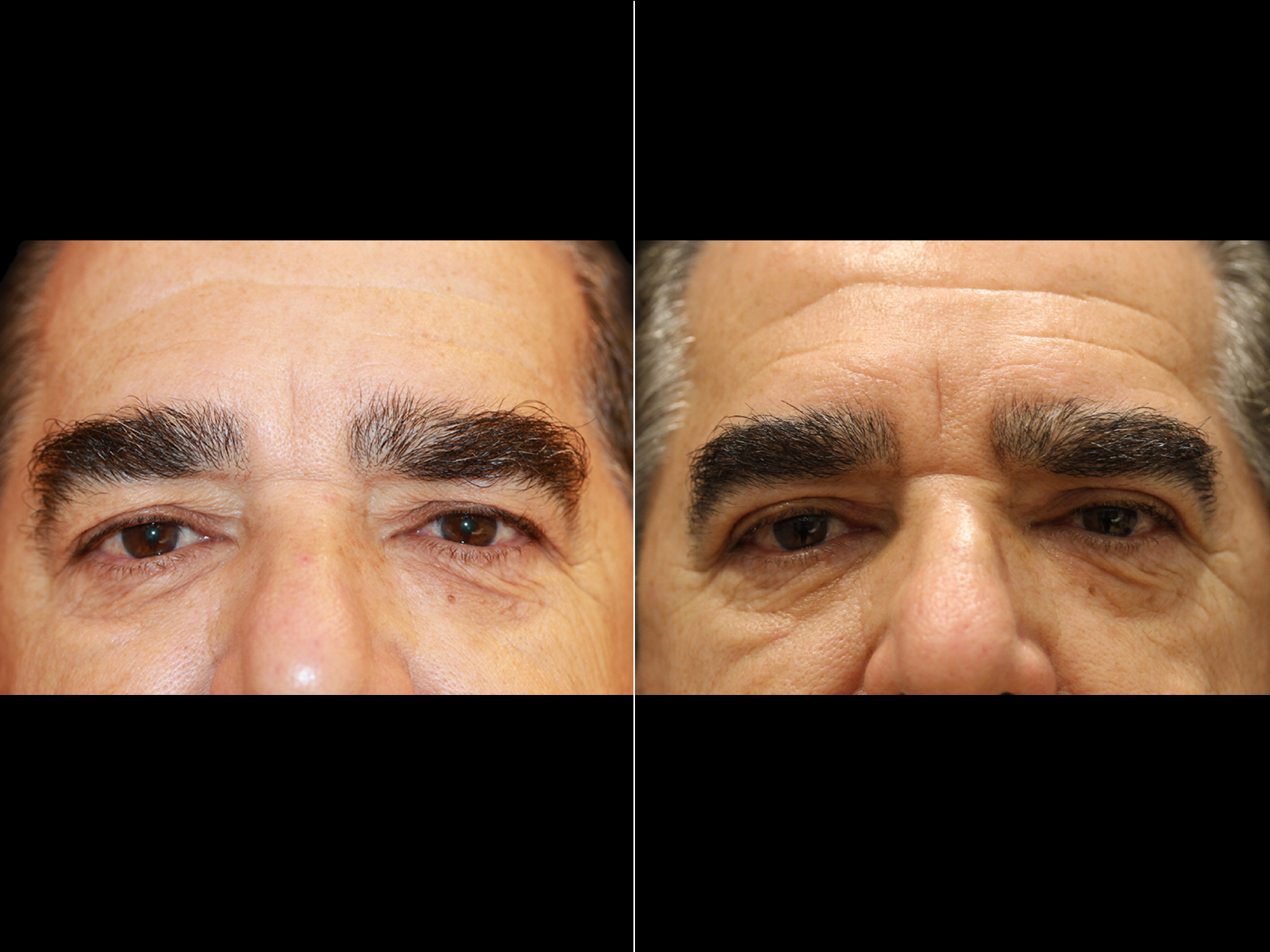 This patient underwent an upper blepharoplasty.