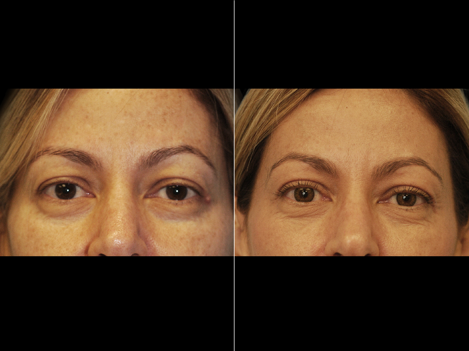 This patient underwent an upper blepharoplasty with fat transfer to the tear trough and nasolabial folds.