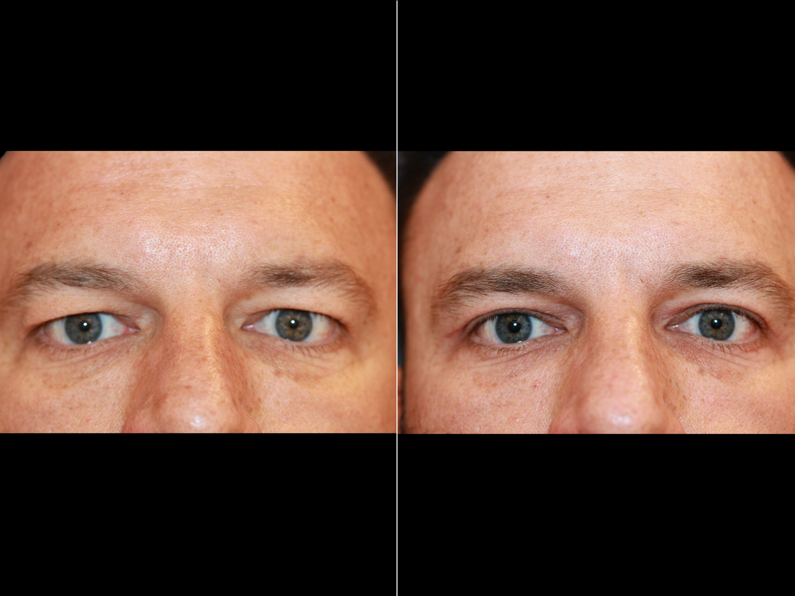 This patient underwent an upper blepharoplasty.
