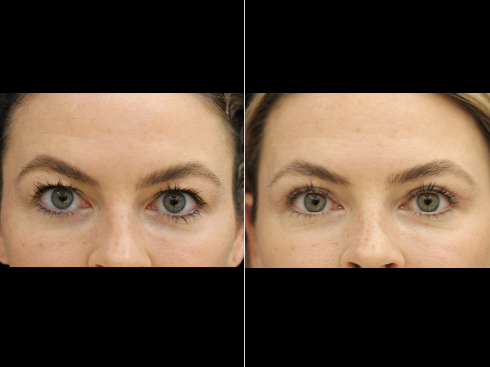 This patient underwent an upper blepharoplasty, temporal brow lift, and fat transfer to the tear trough.