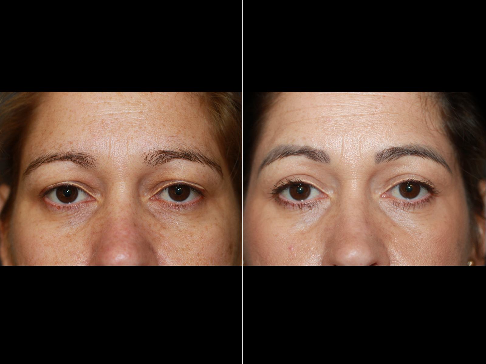 This patient underwent an upper blepharoplasty.