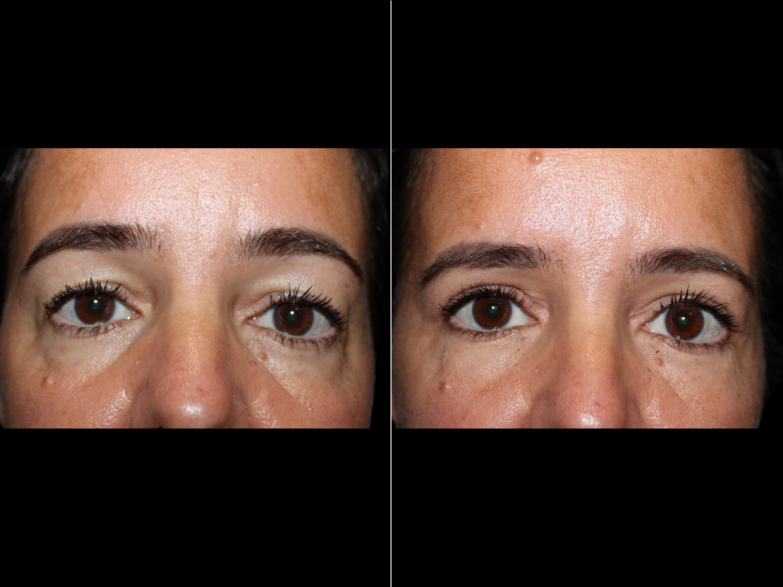 This patient underwent a quad blepharoplasty with fat transfer to the tear trough.