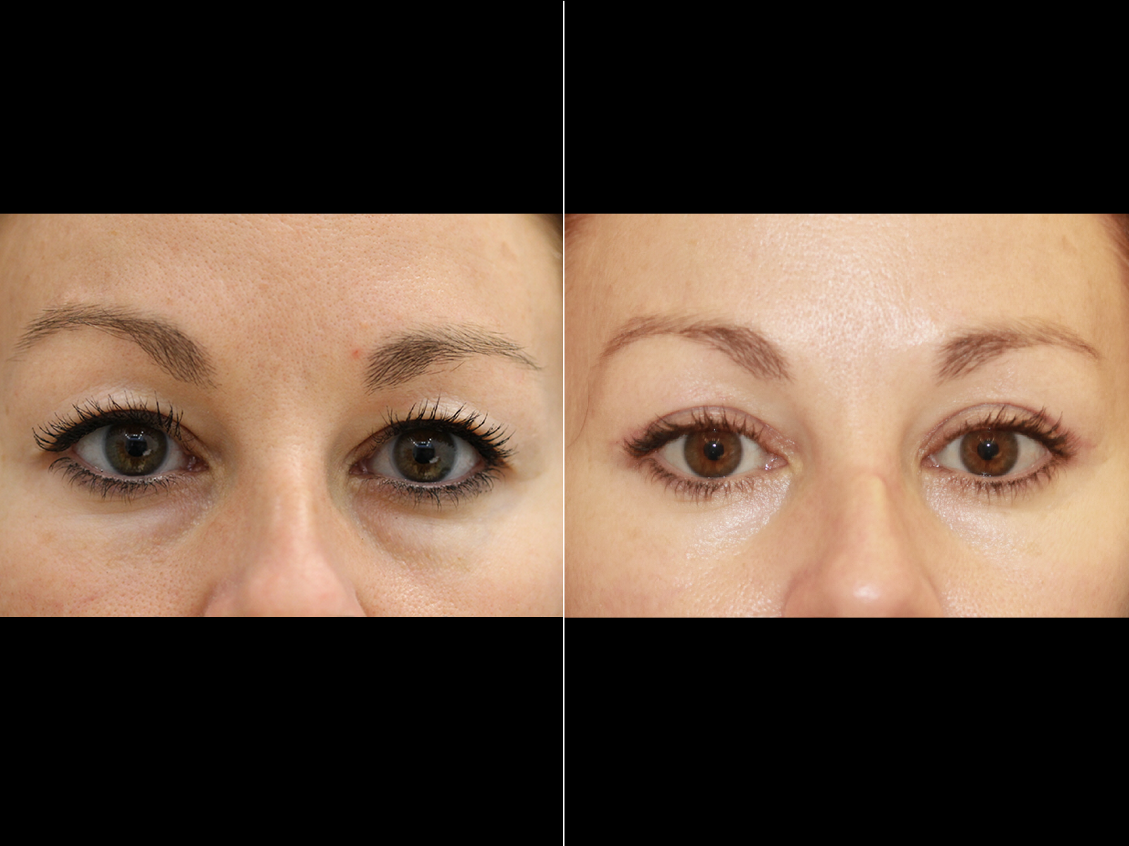 This patient underwent an upper blepharoplasty.