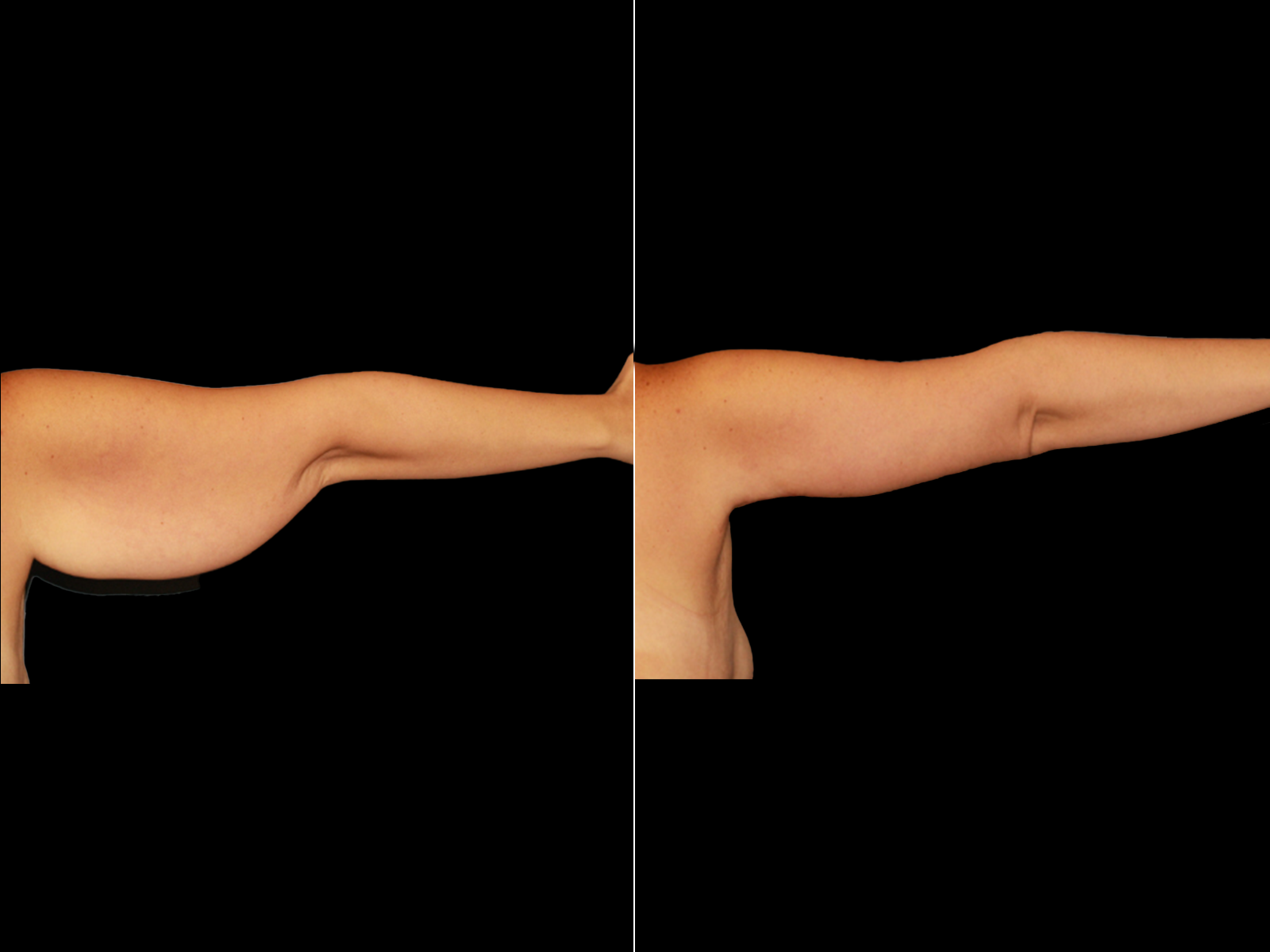 This patient underwent an extended brachioplasty.