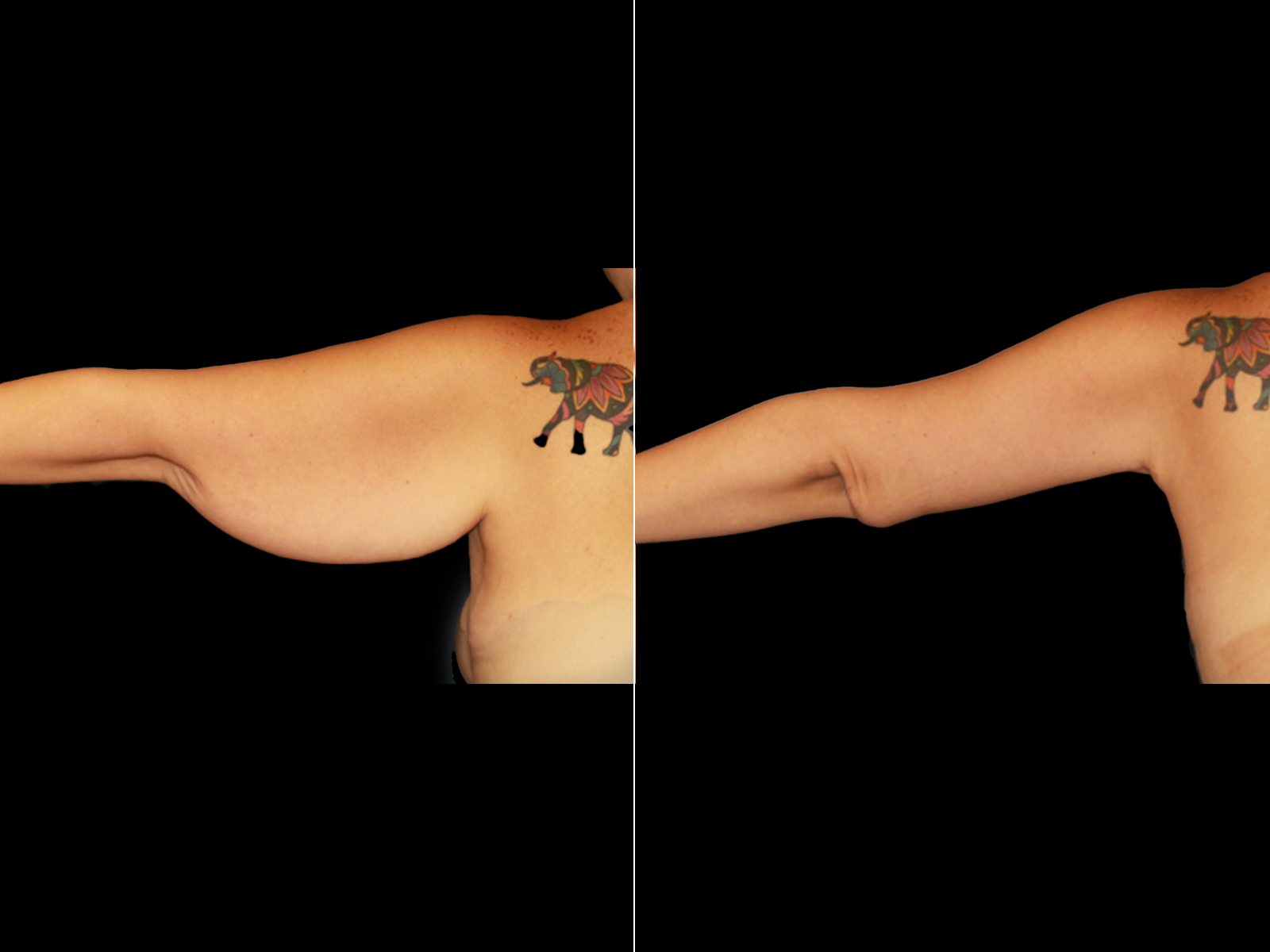 This patient underwent an extended brachioplasty.