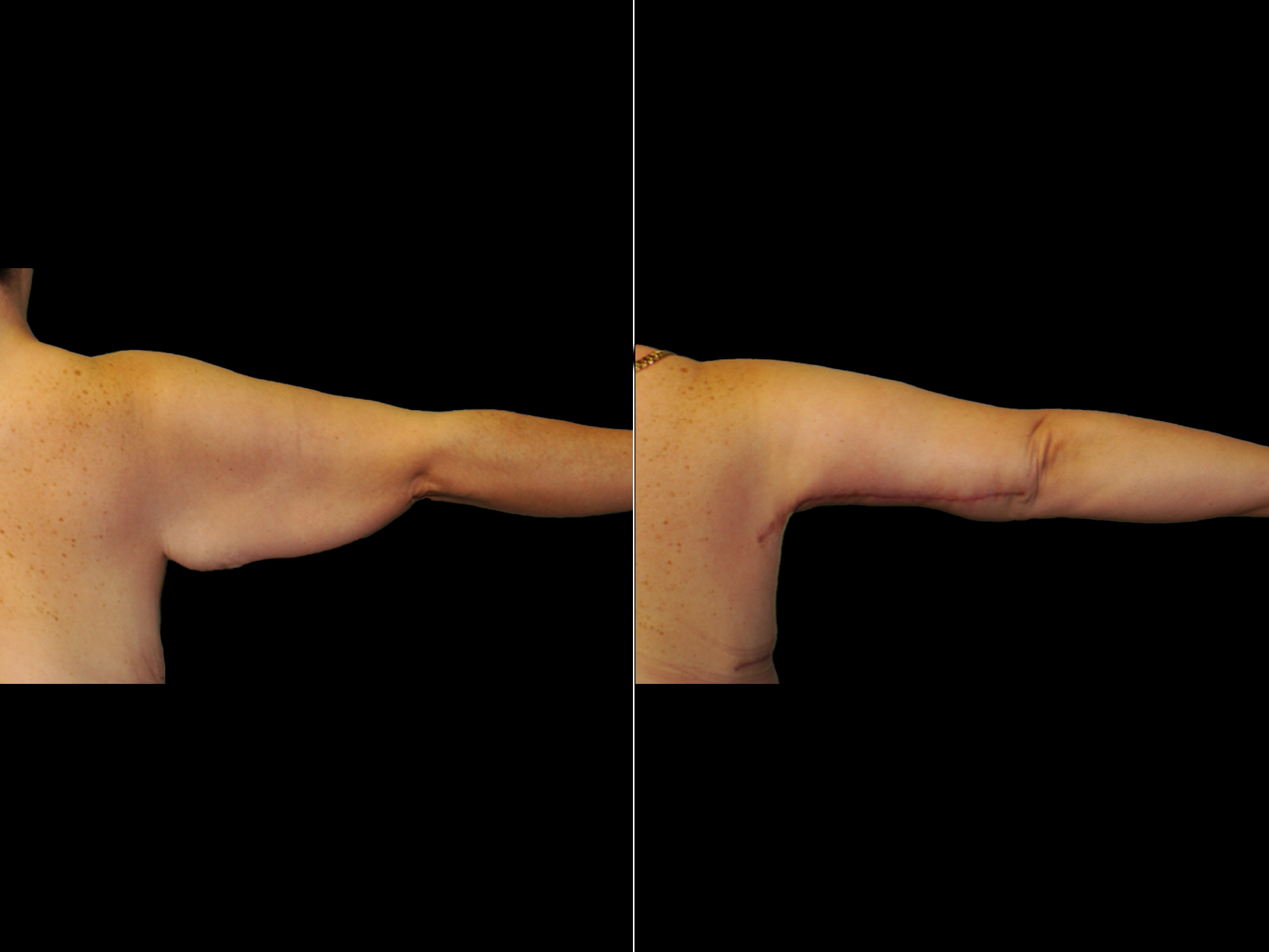 This patient underwent an extended brachioplasty.