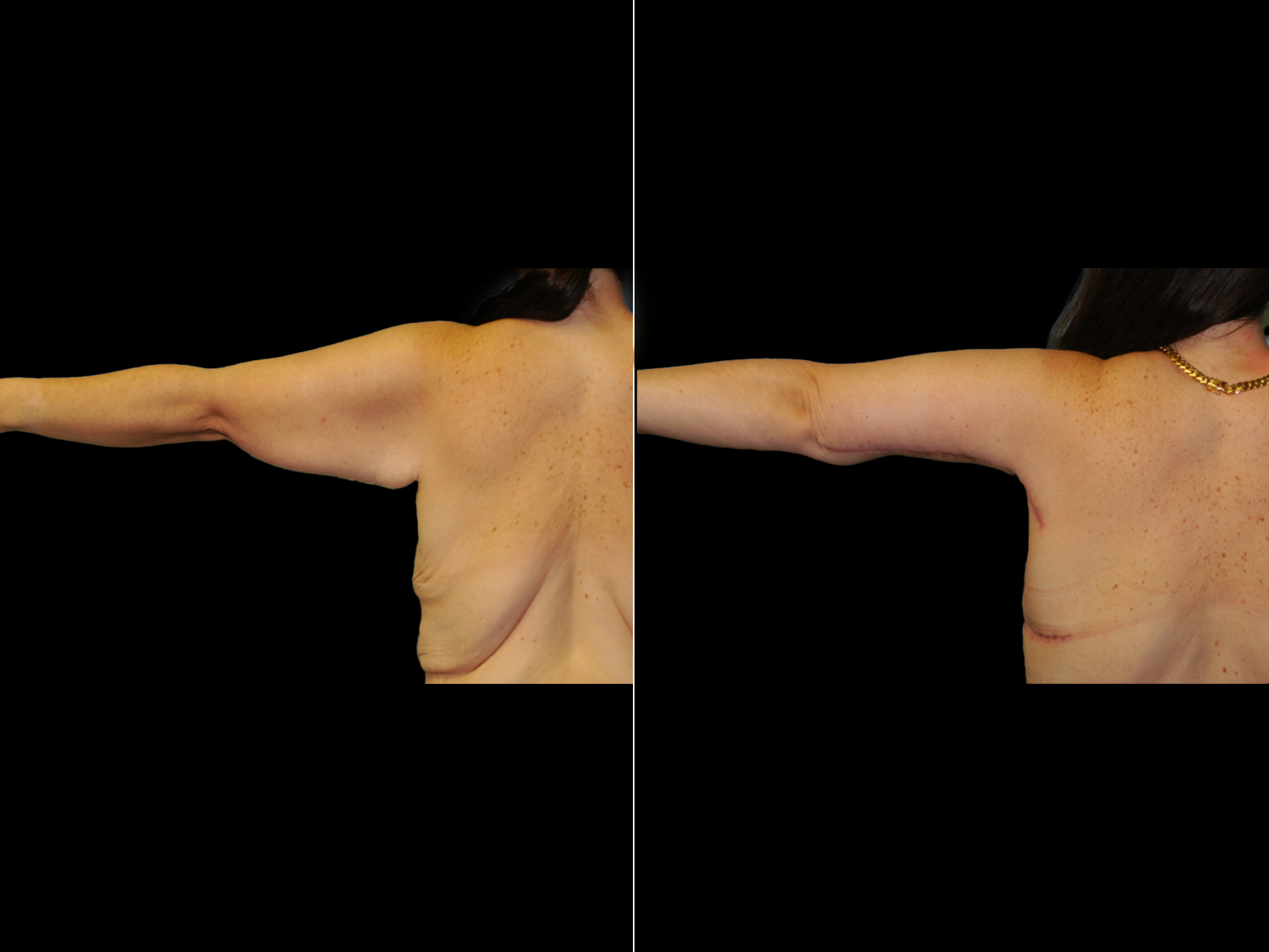 This patient underwent a standard brachioplasty.