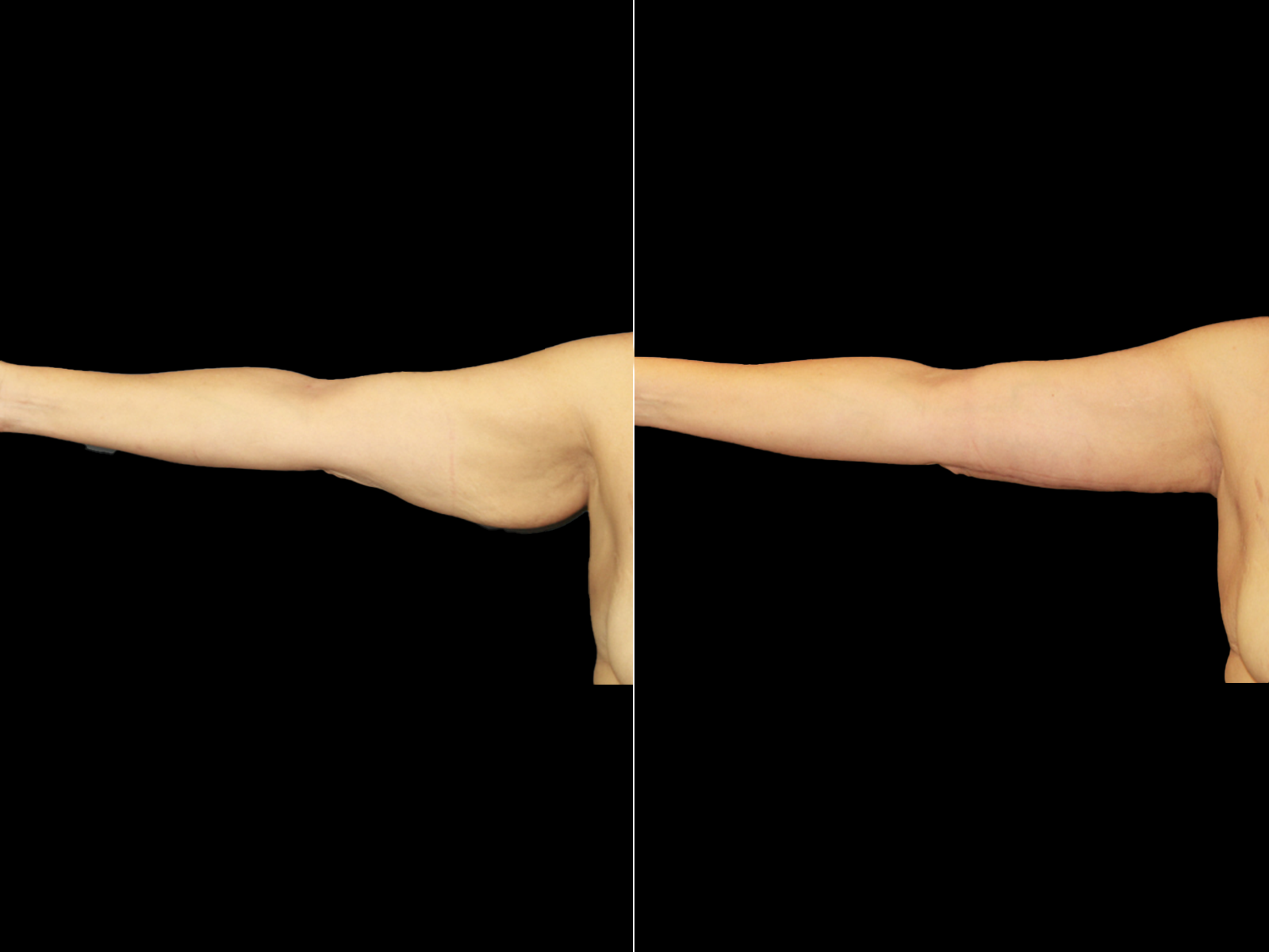 This patient underwent an extended brachioplasty.