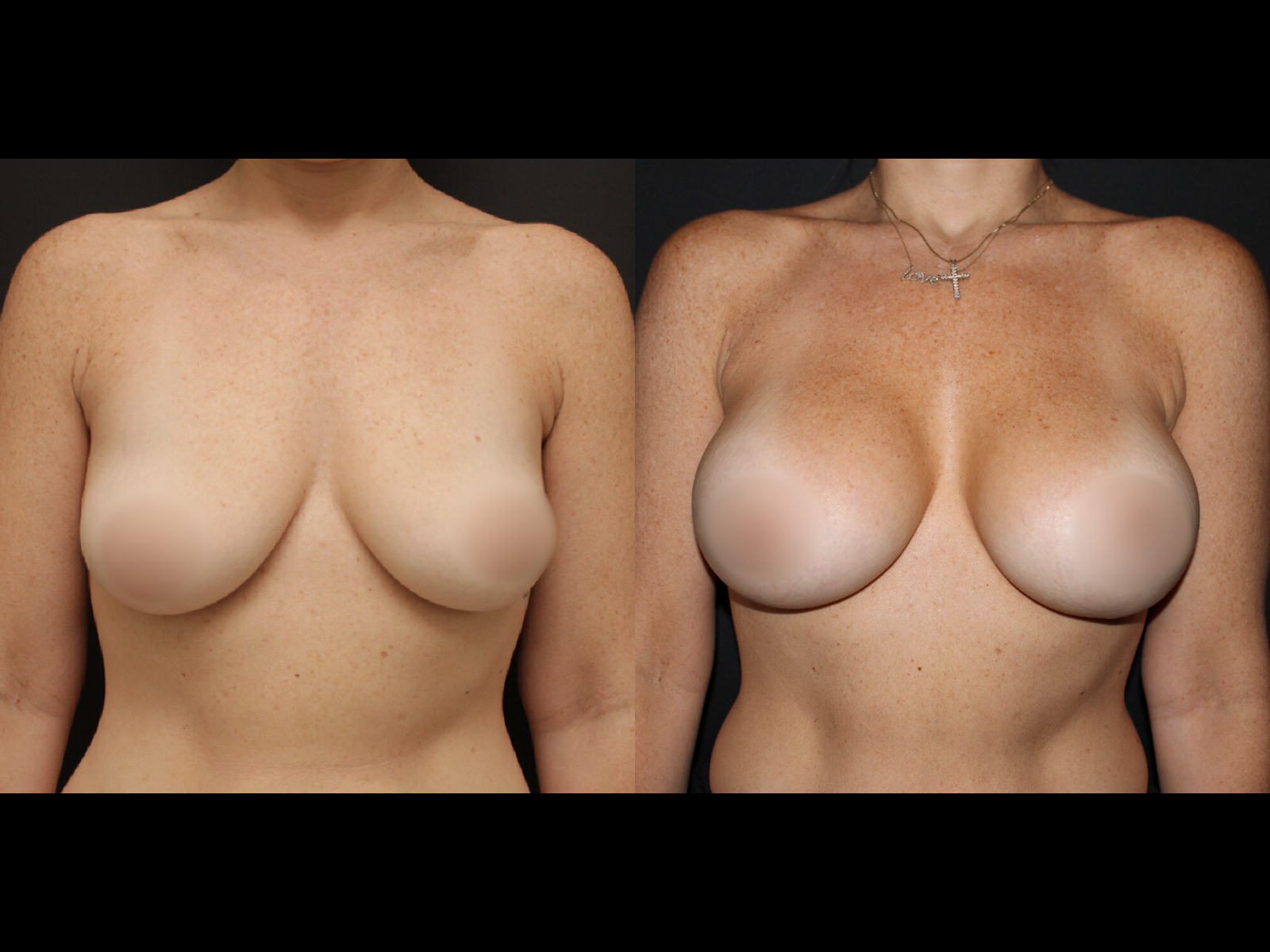 breast-augmentation-before-and-after-dr-soler-baillo-coral-gables-01 (2)