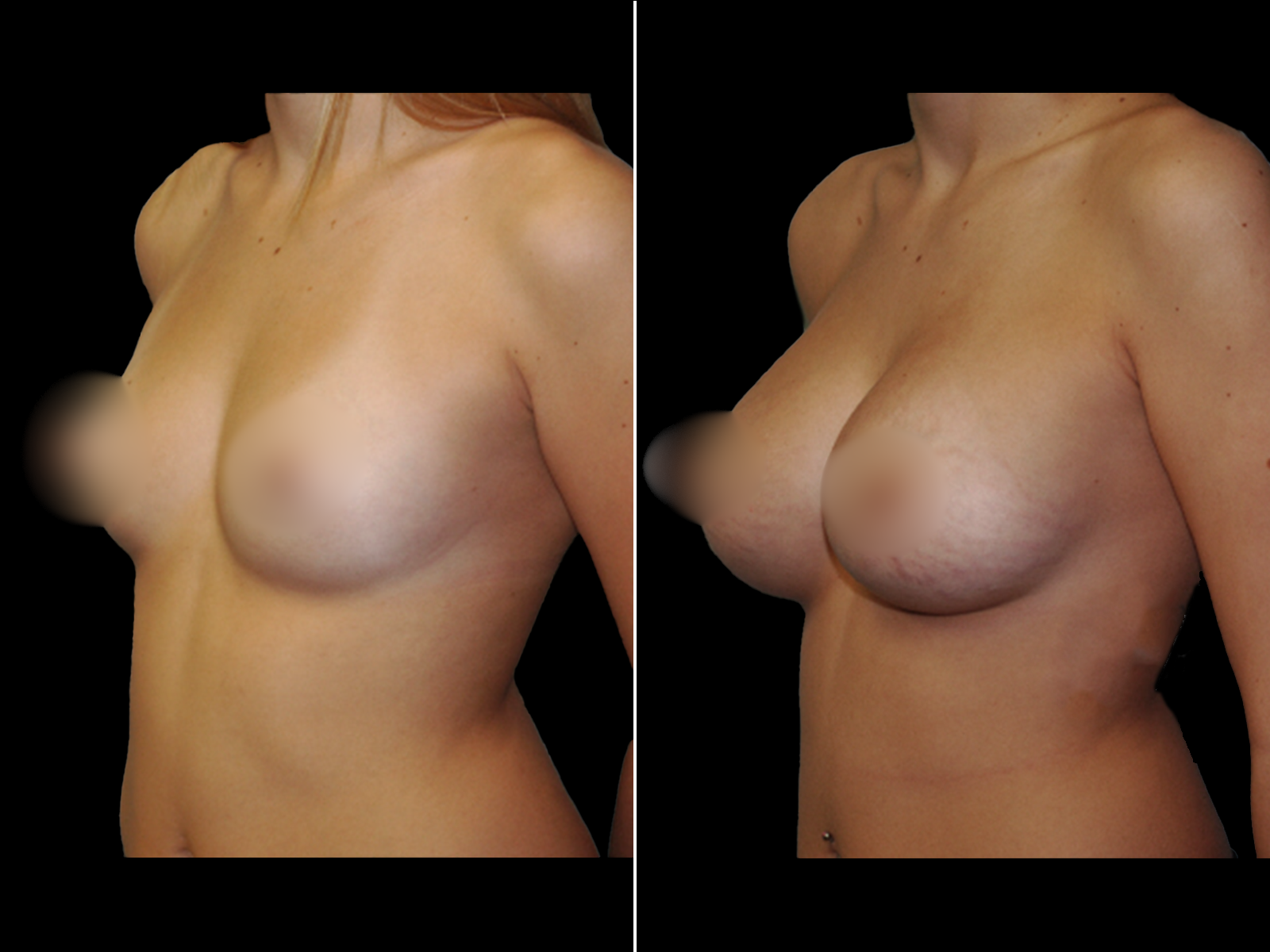 breast-augmentation-before-and-after-dr-soler-baillo-coral-gables-03