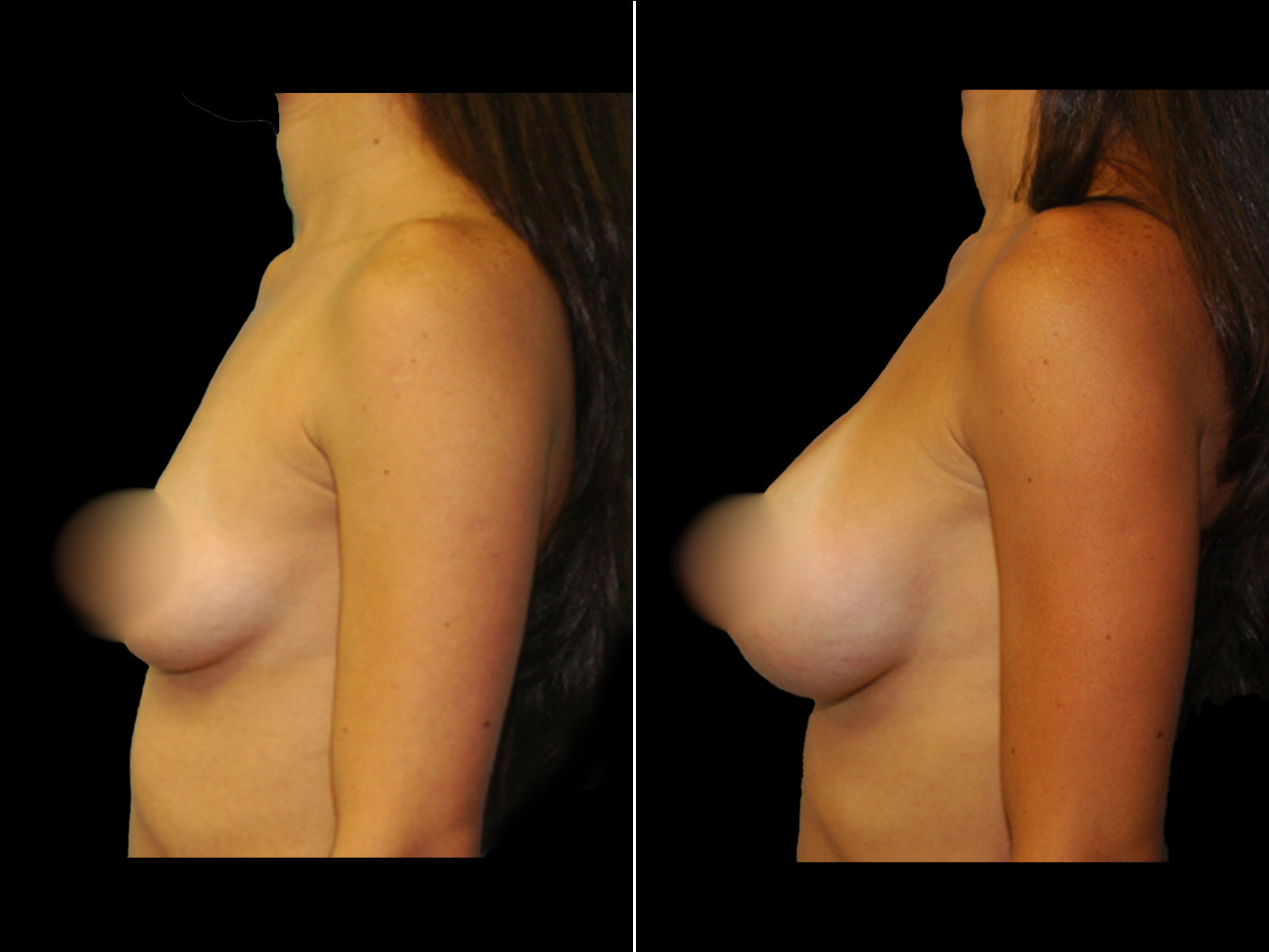 breast-augmentation-before-and-after-dr-soler-baillo-coral-gables-07