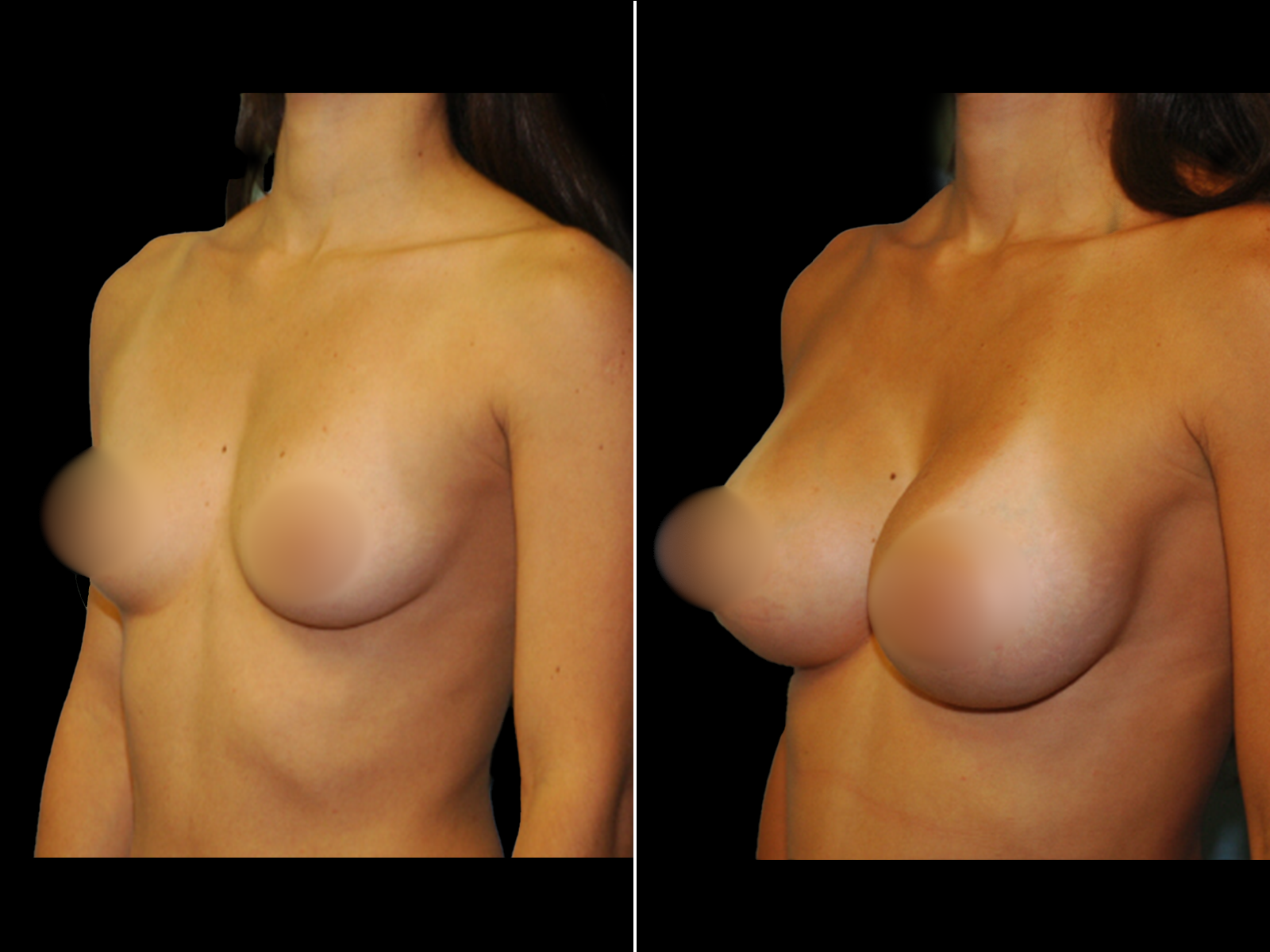breast-augmentation-before-and-after-dr-soler-baillo-coral-gables-08