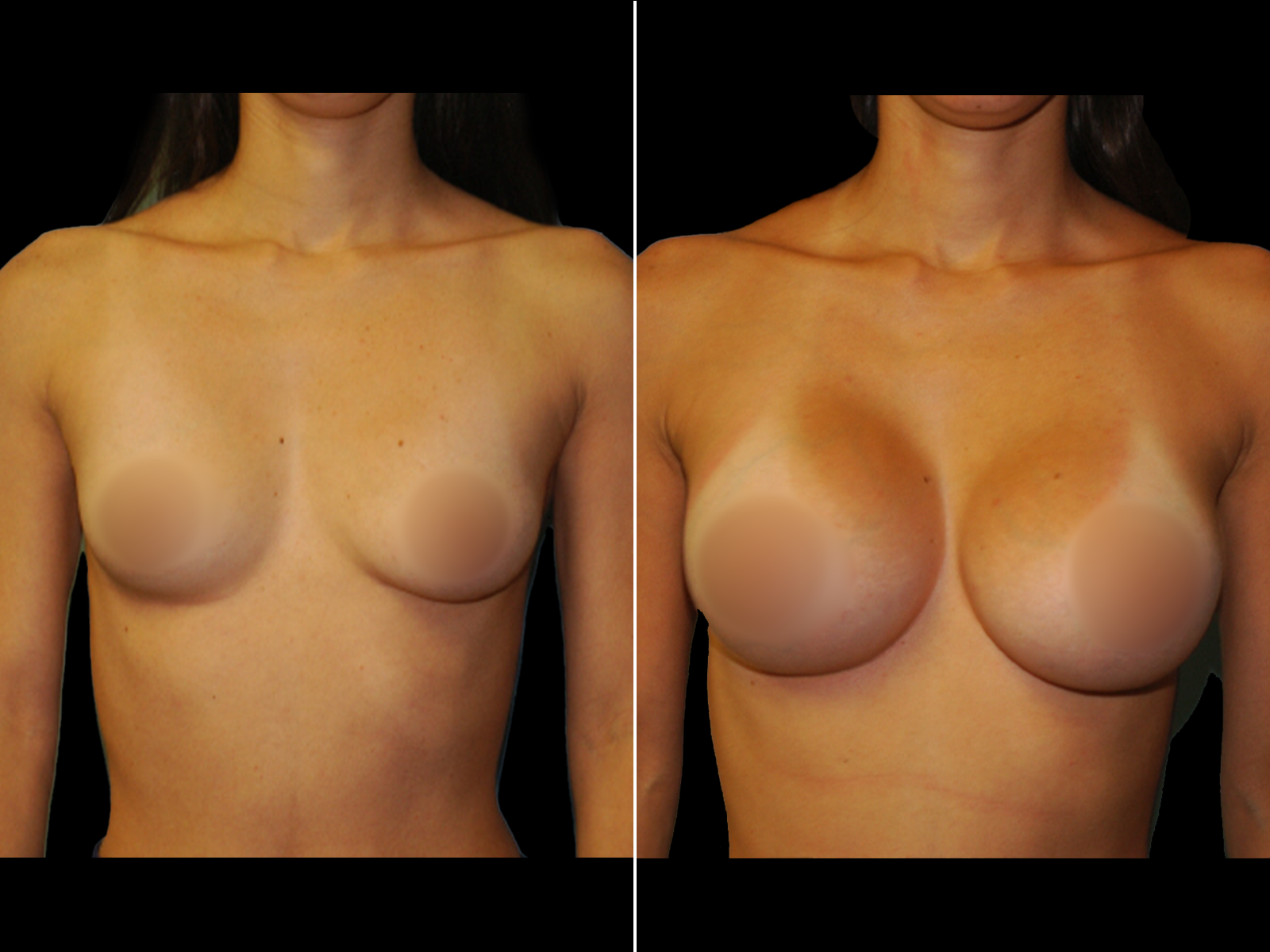 breast-augmentation-before-and-after-dr-soler-baillo-coral-gables-09
