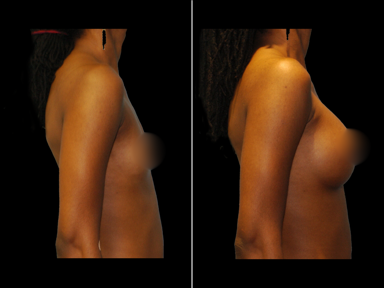 breast-augmentation-before-and-after-dr-soler-baillo-coral-gables-10