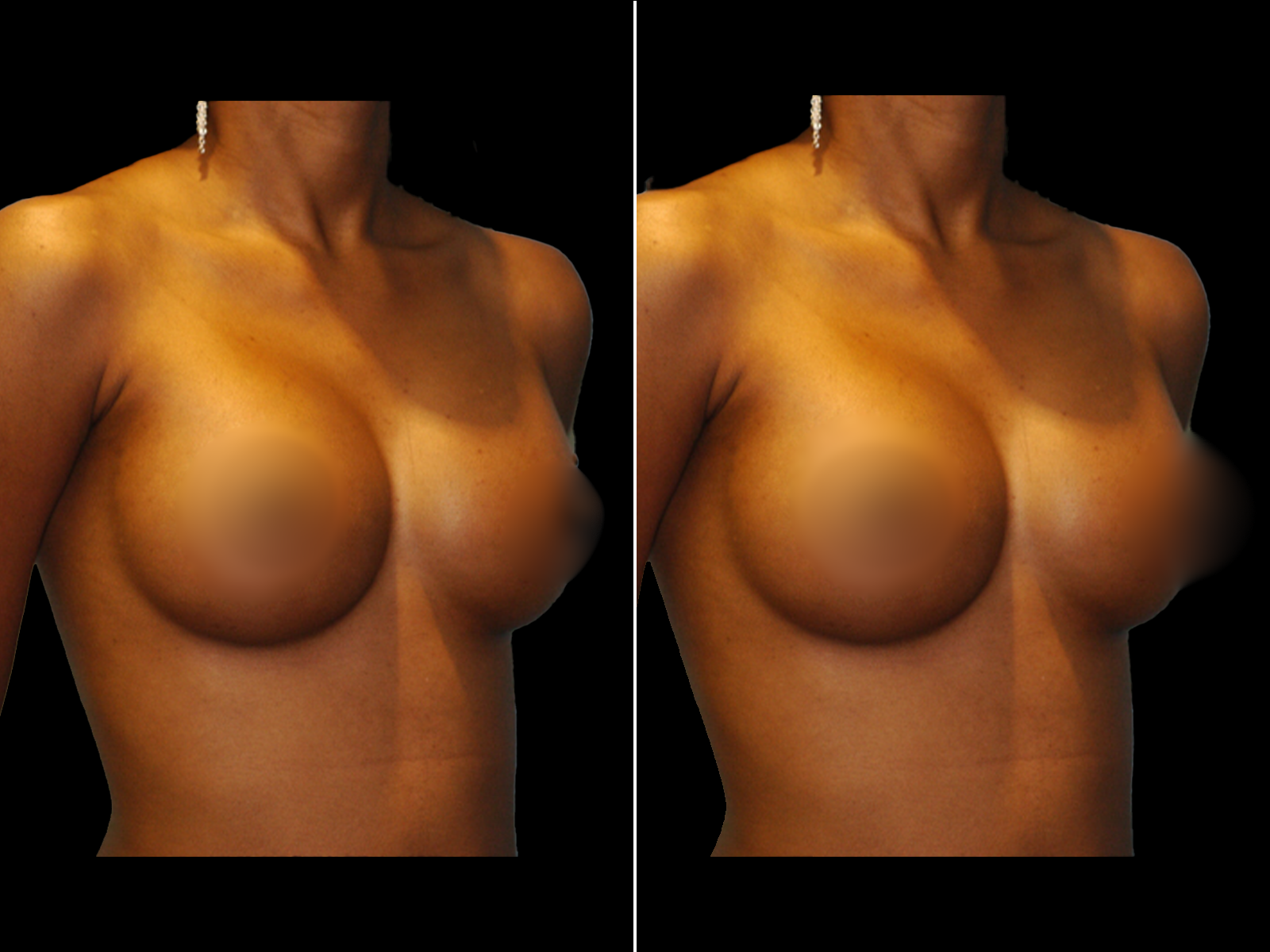 breast-augmentation-before-and-after-dr-soler-baillo-coral-gables-11