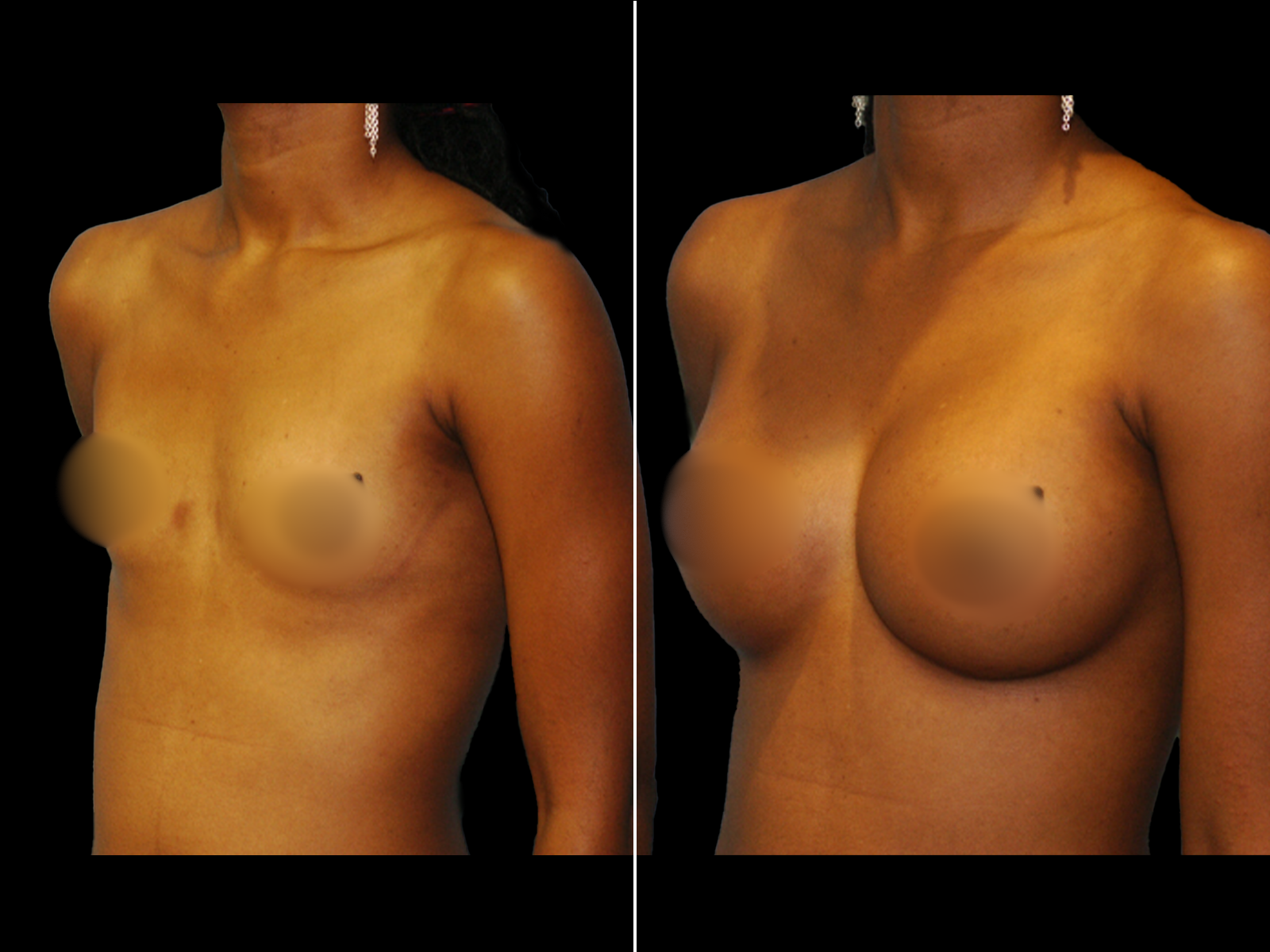 breast-augmentation-before-and-after-dr-soler-baillo-coral-gables-12