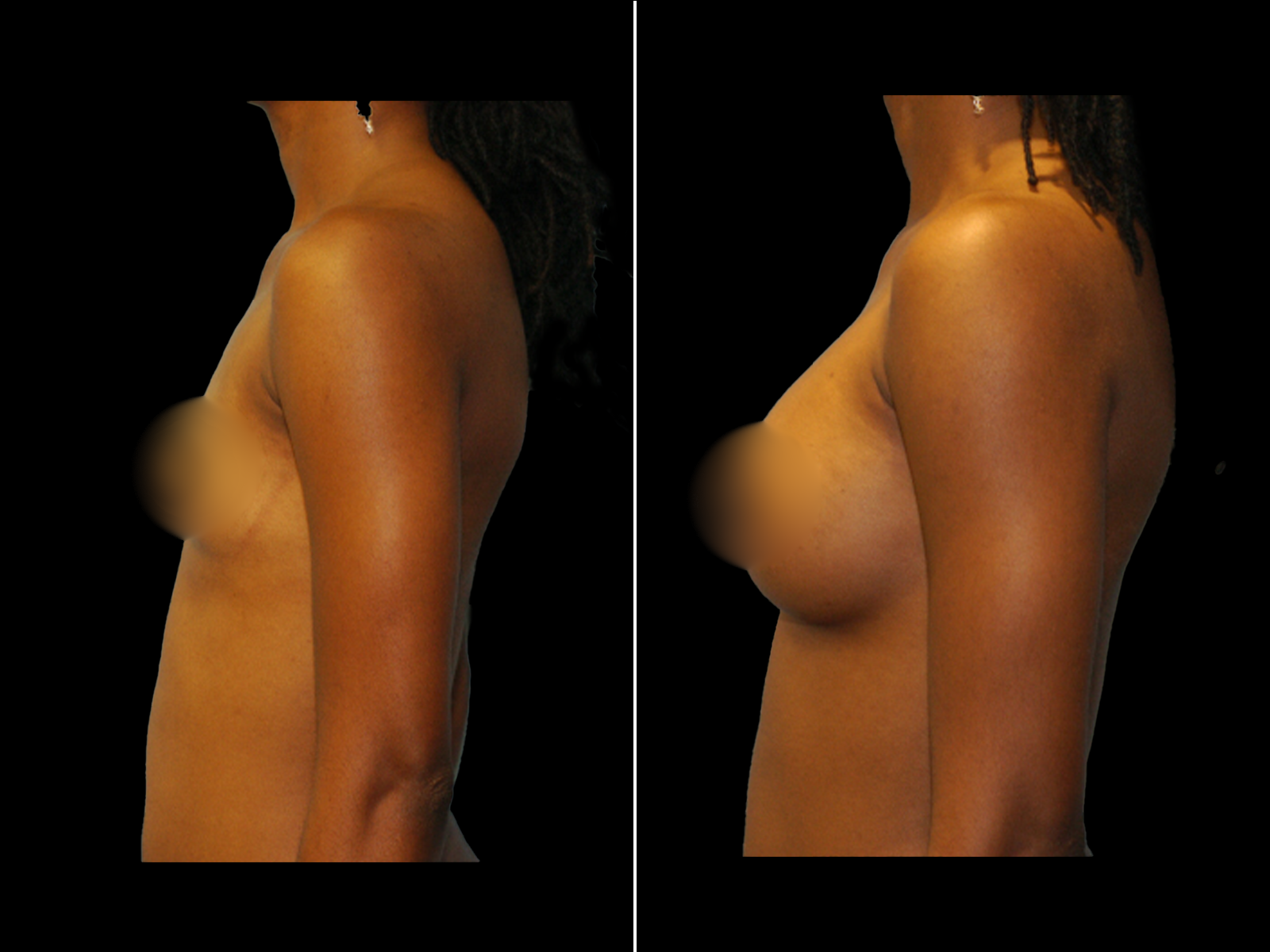 breast-augmentation-before-and-after-dr-soler-baillo-coral-gables-13
