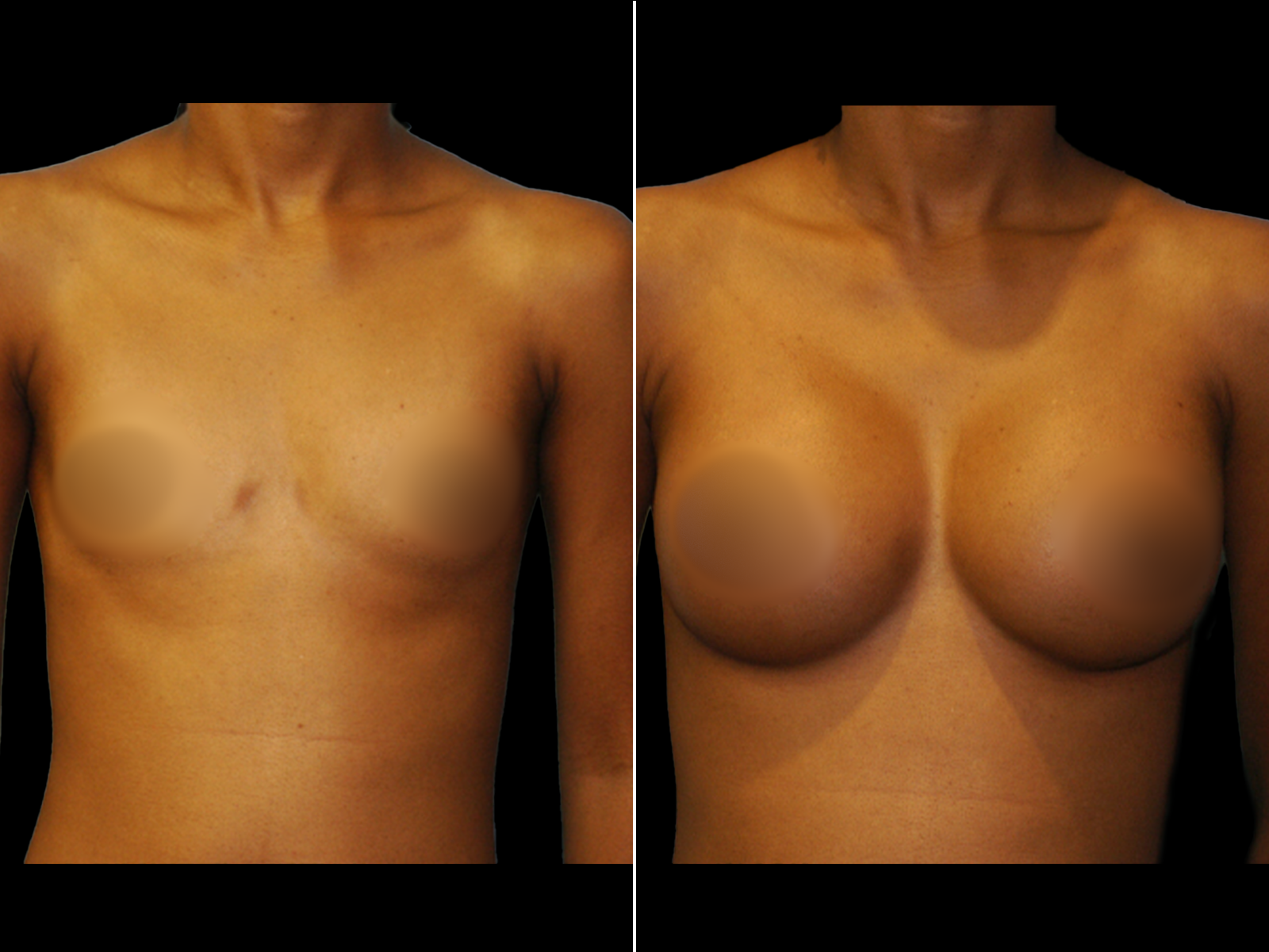 breast-augmentation-before-and-after-dr-soler-baillo-coral-gables-14