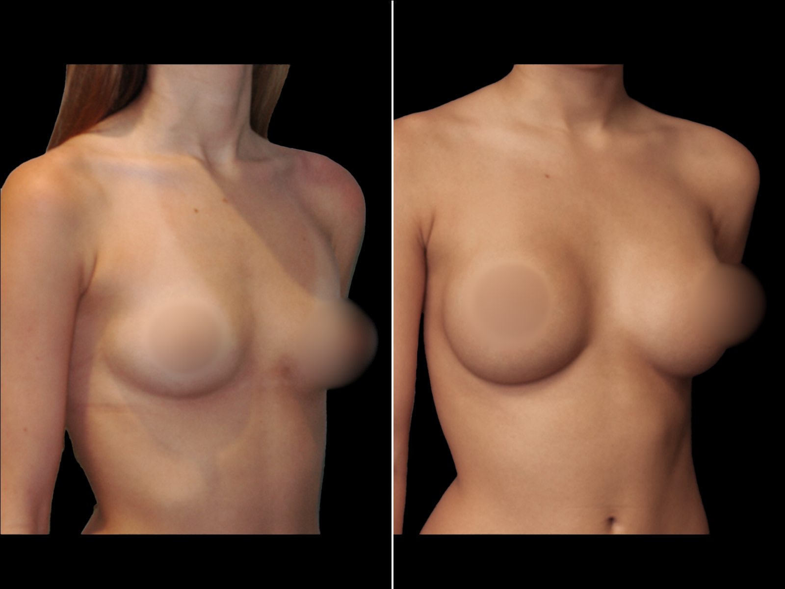 breast-augmentation-before-and-after-dr-soler-baillo-coral-gables-15
