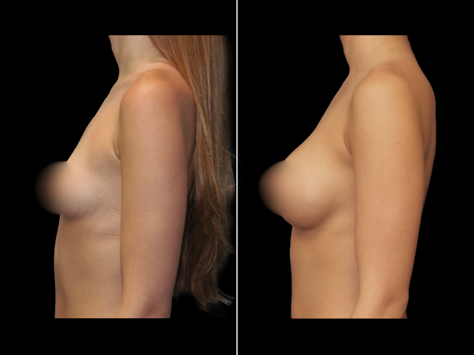 breast-augmentation-before-and-after-dr-soler-baillo-coral-gables-16