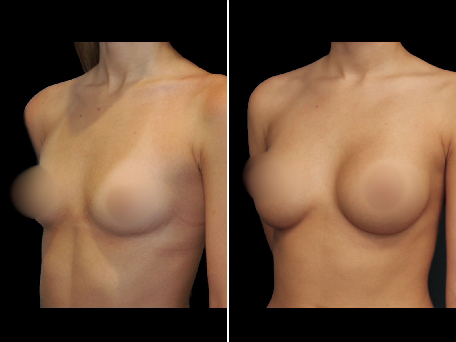 breast-augmentation-before-and-after-dr-soler-baillo-coral-gables-17