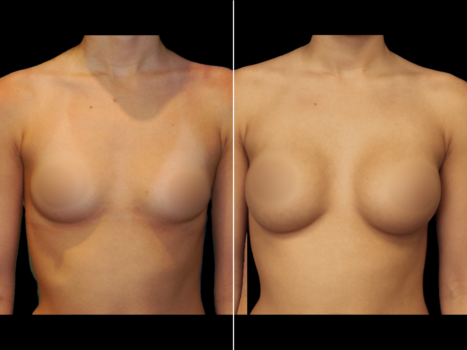 breast-augmentation-before-and-after-dr-soler-baillo-coral-gables-18