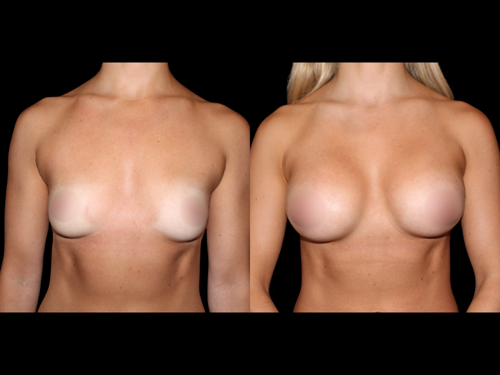 breast-augmentation-before-and-after-dr-soler-baillo-coral-gables-20