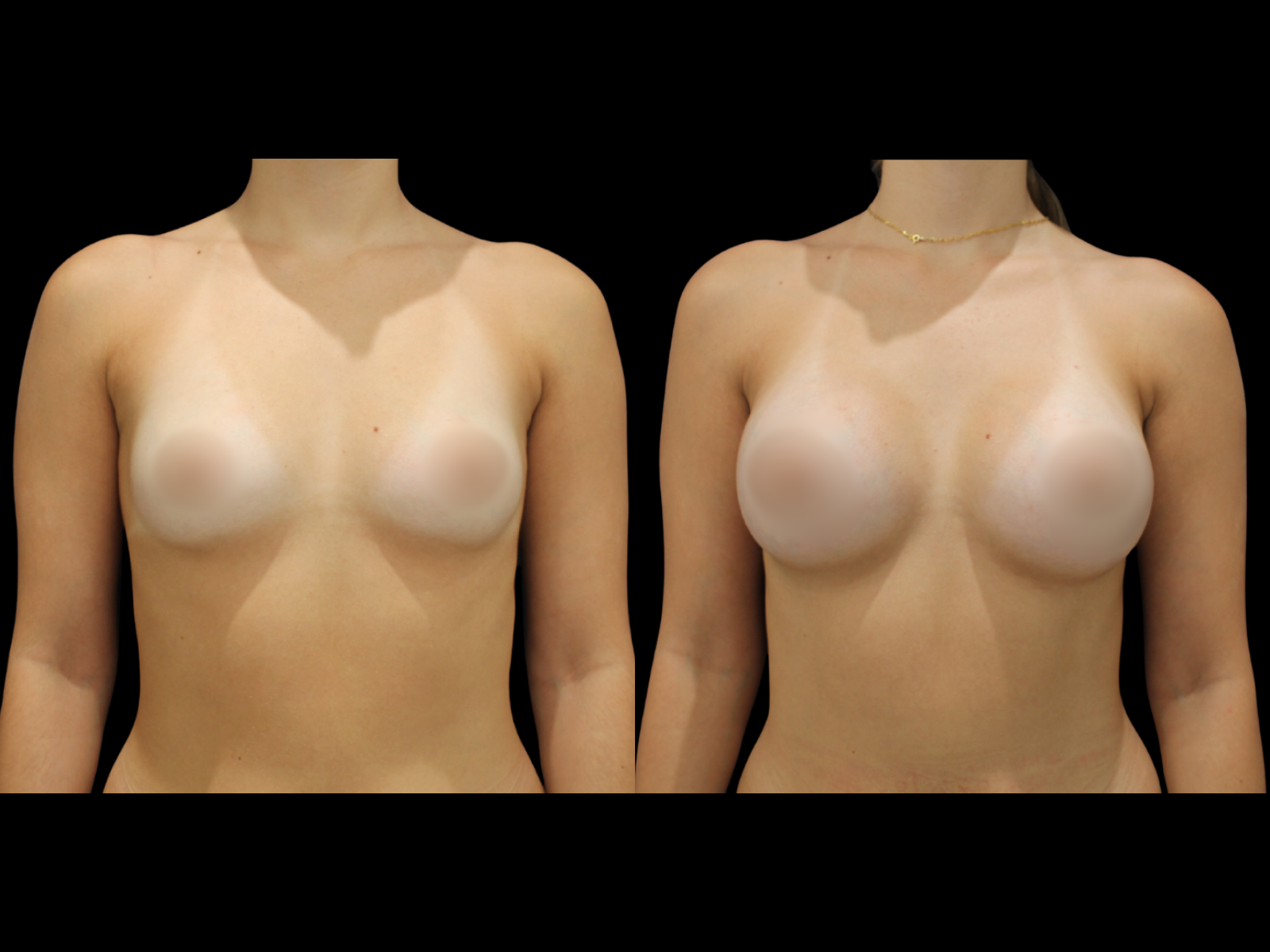 breast-augmentation-before-and-after-dr-soler-baillo-coral-gables-21
