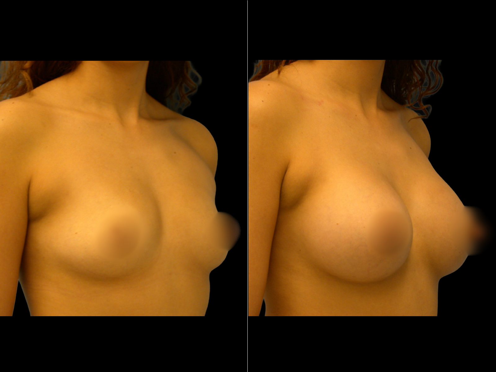 breast-augmentation-periareolar-before-and-after-dr-soler-baillo-coral-gables-01