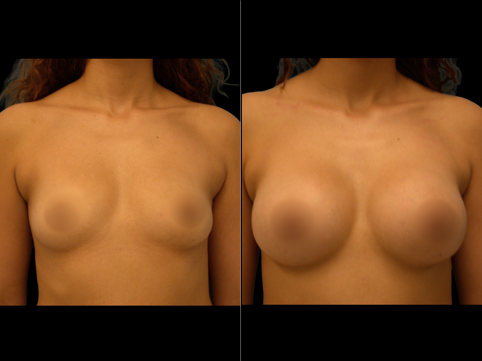 breast-augmentation-periareolar-before-and-after-dr-soler-baillo-coral-gables-02