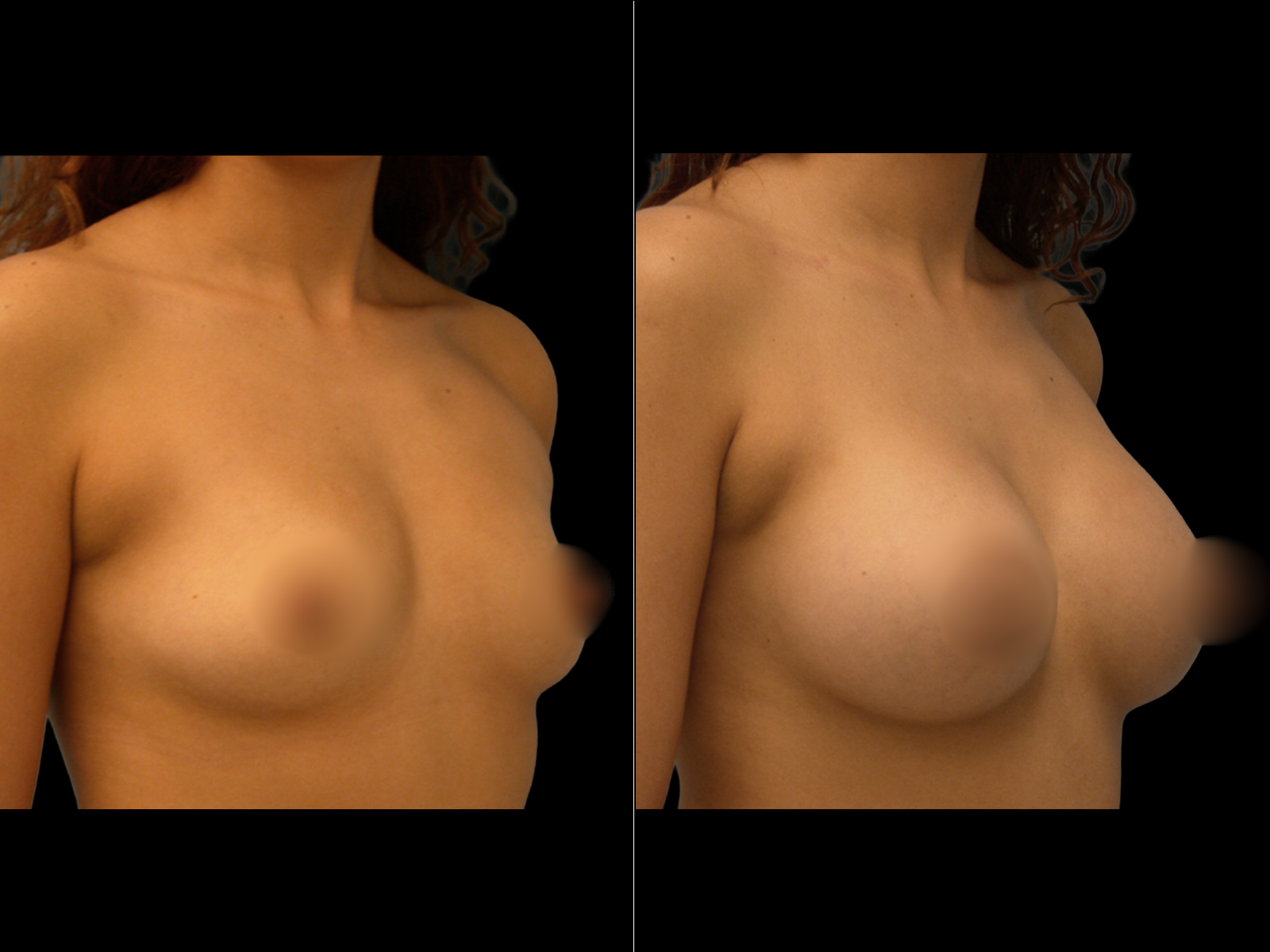 breast-augmentation-periareolar-before-and-after-dr-soler-baillo-coral-gables-03
