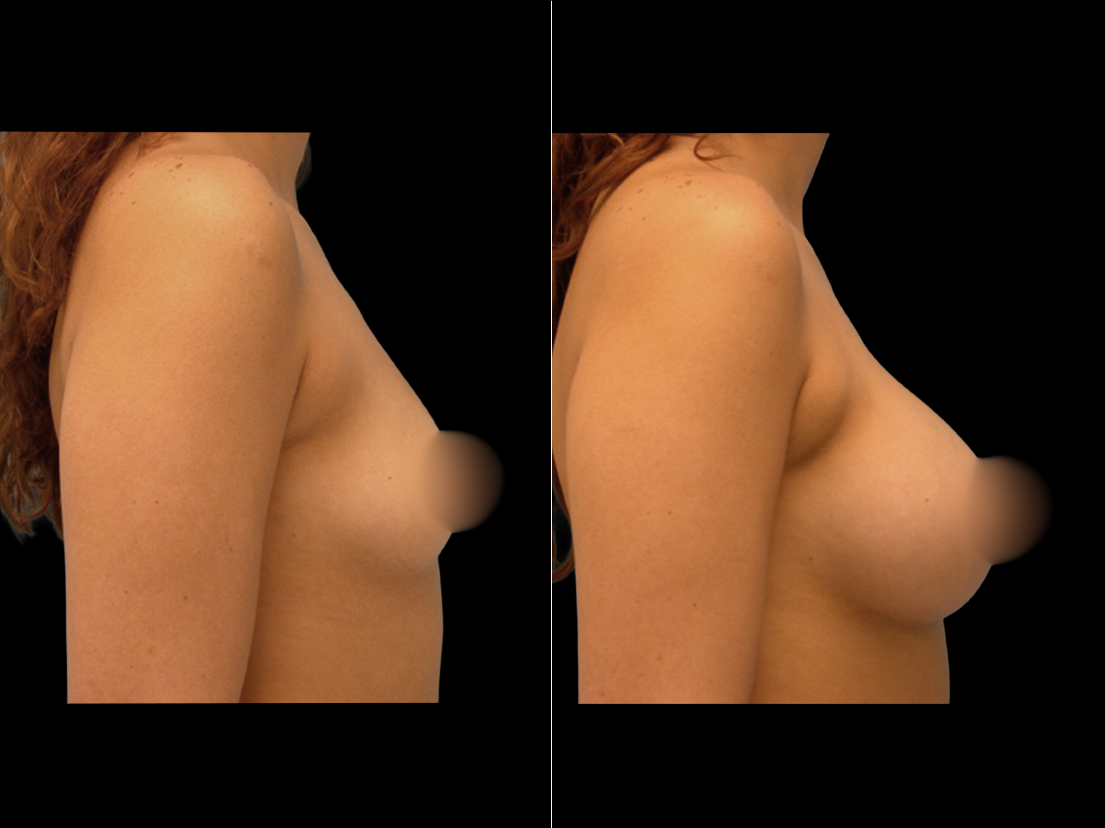 breast-augmentation-periareolar-before-and-after-dr-soler-baillo-coral-gables-04