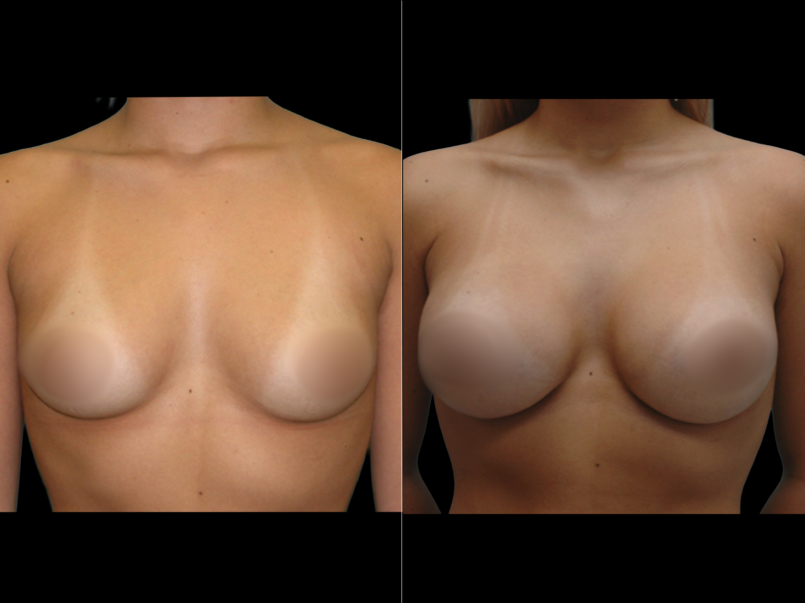 breast-augmentation-periareolar-before-and-after-dr-soler-baillo-coral-gables-06