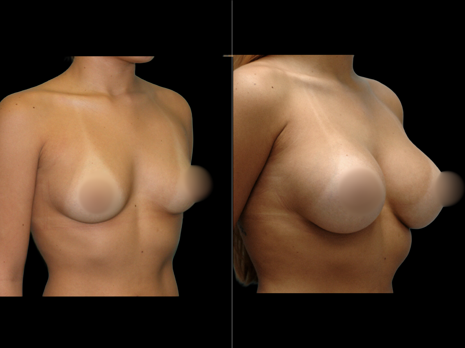 breast-augmentation-periareolar-before-and-after-dr-soler-baillo-coral-gables-07