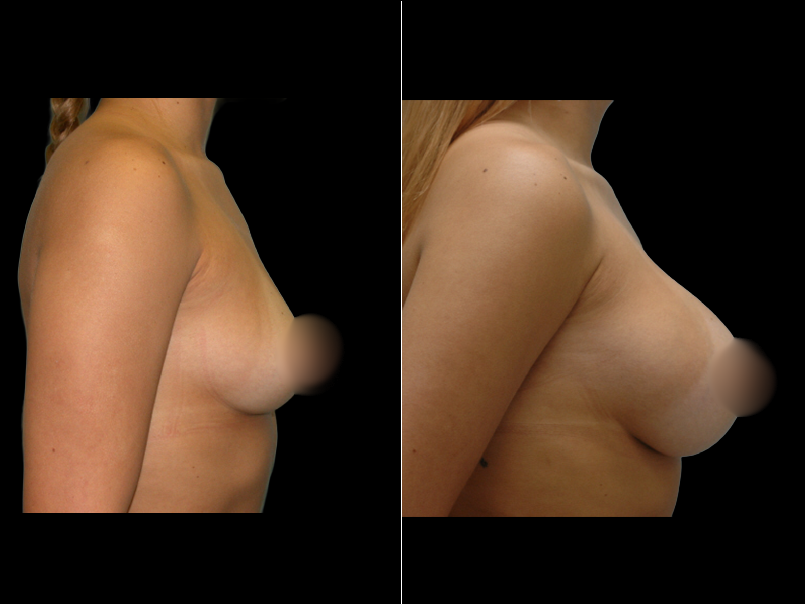 breast-augmentation-periareolar-before-and-after-dr-soler-baillo-coral-gables-08