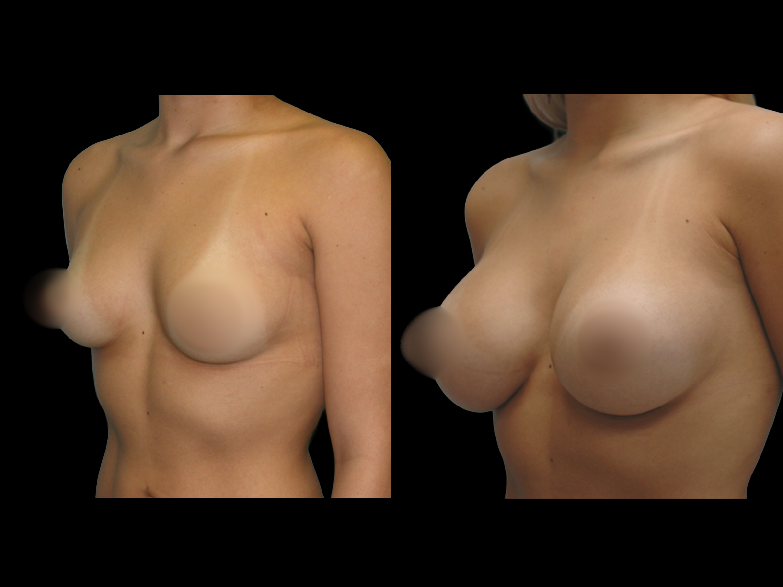 breast-augmentation-periareolar-before-and-after-dr-soler-baillo-coral-gables-09