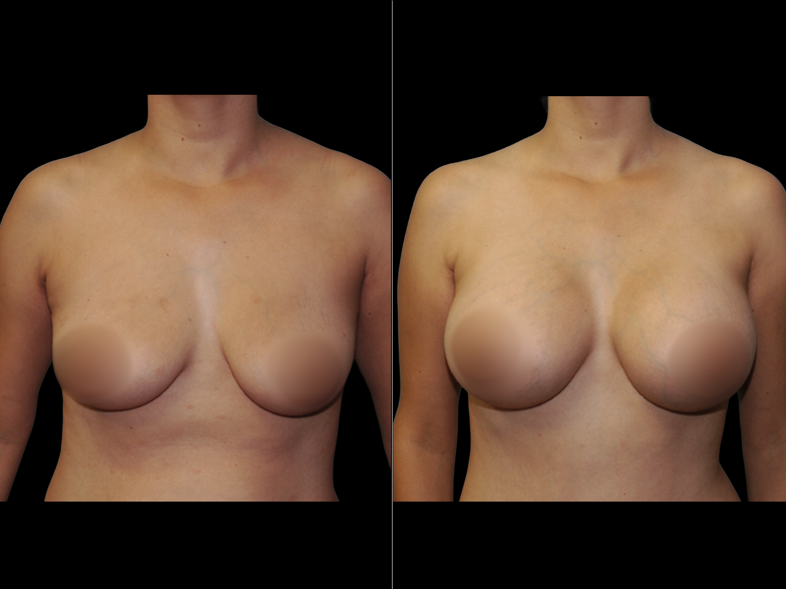 breast-augmentation-periareolar-before-and-after-dr-soler-baillo-coral-gables-10