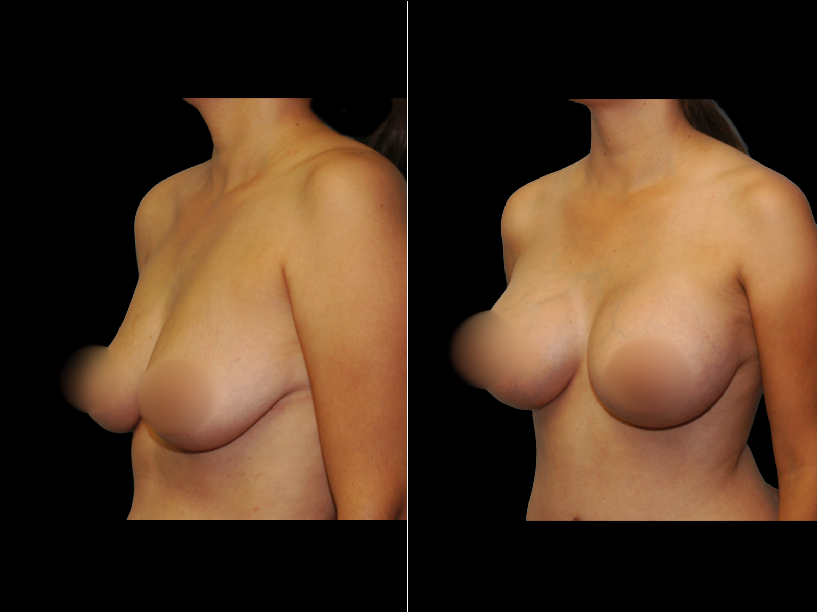 breast-augmentation-periareolar-before-and-after-dr-soler-baillo-coral-gables-11