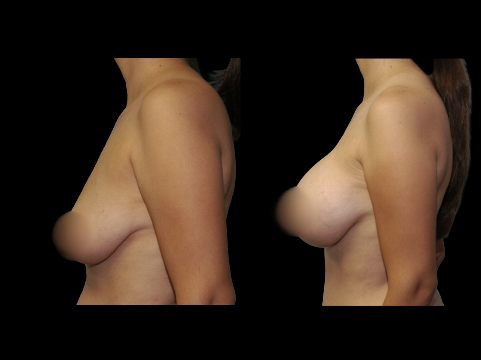 breast-augmentation-periareolar-before-and-after-dr-soler-baillo-coral-gables-12