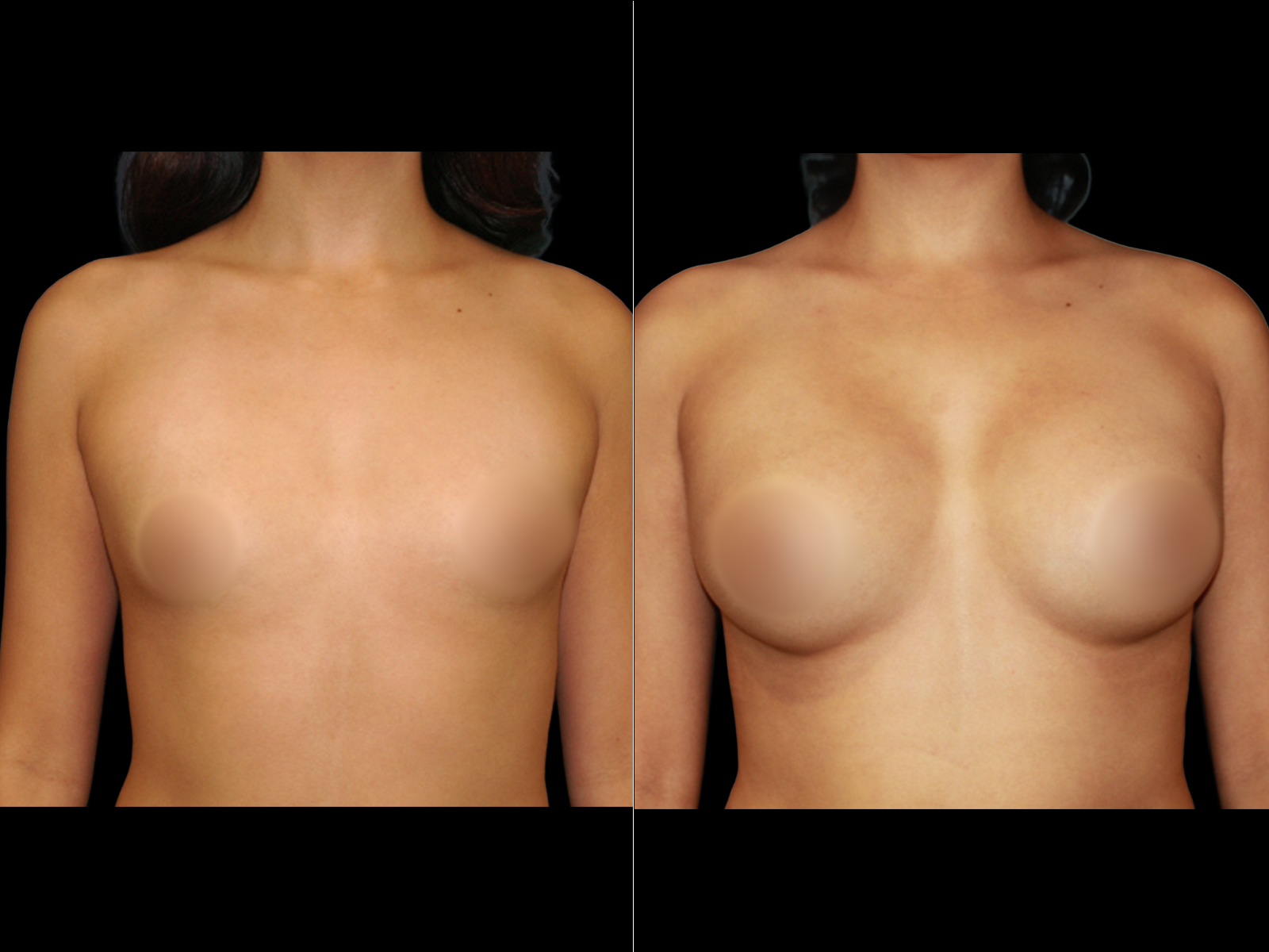 breast-augmentation-periareolar-before-and-after-dr-soler-baillo-coral-gables-13 (1)