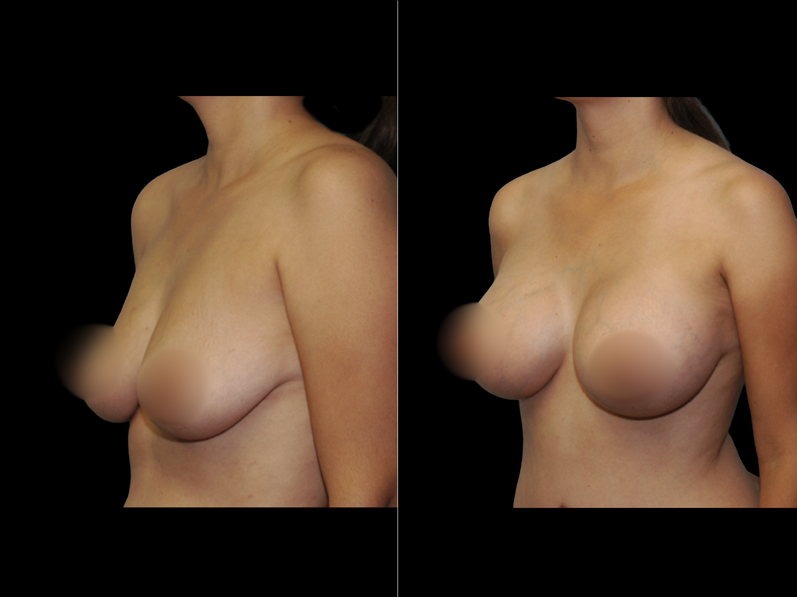 breast-augmentation-periareolar-before-and-after-dr-soler-baillo-coral-gables-13