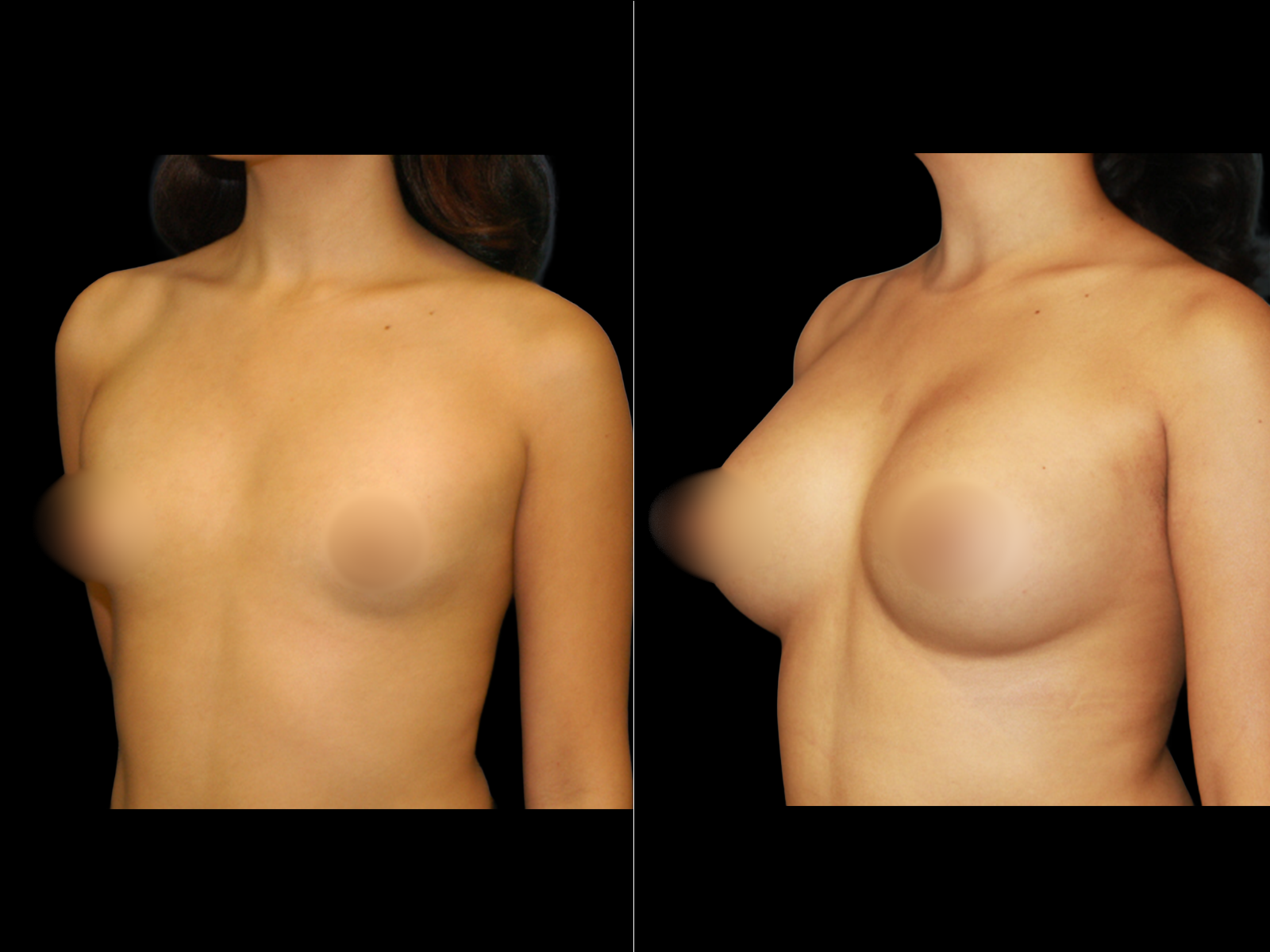 breast-augmentation-periareolar-before-and-after-dr-soler-baillo-coral-gables-14