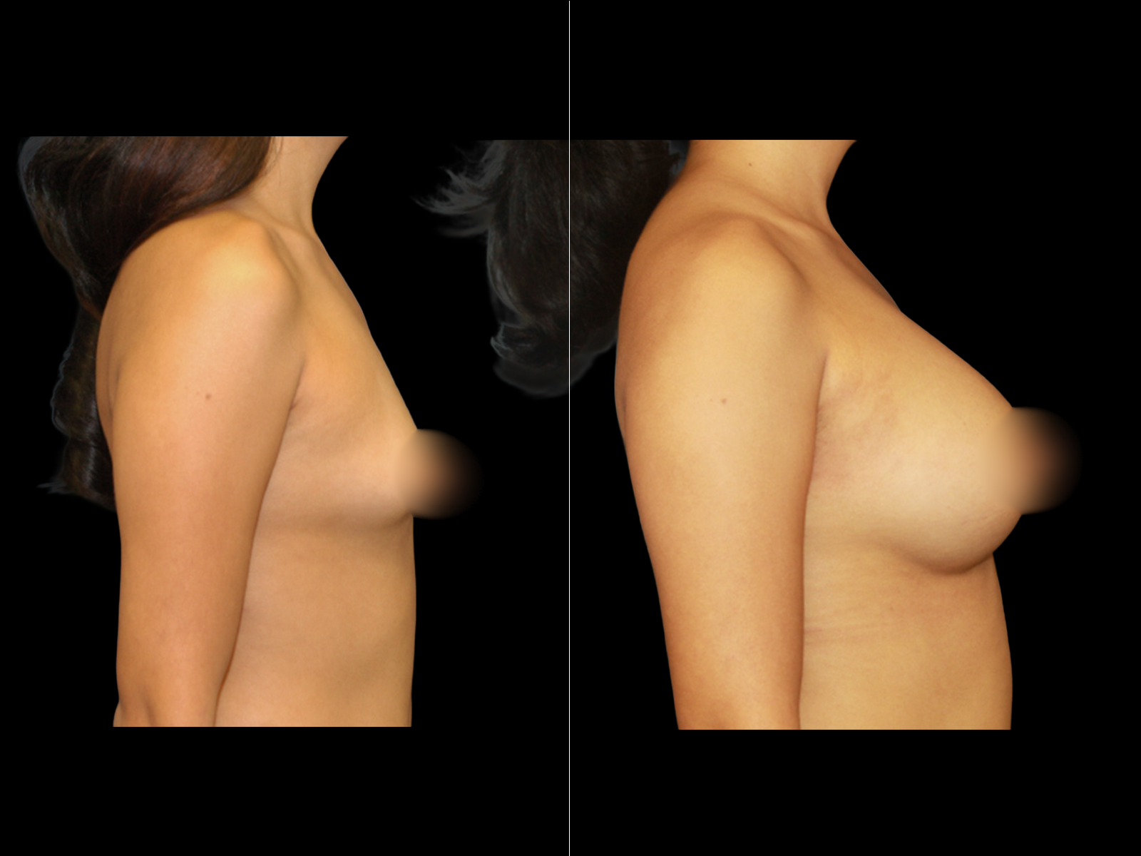 breast-augmentation-periareolar-before-and-after-dr-soler-baillo-coral-gables-15