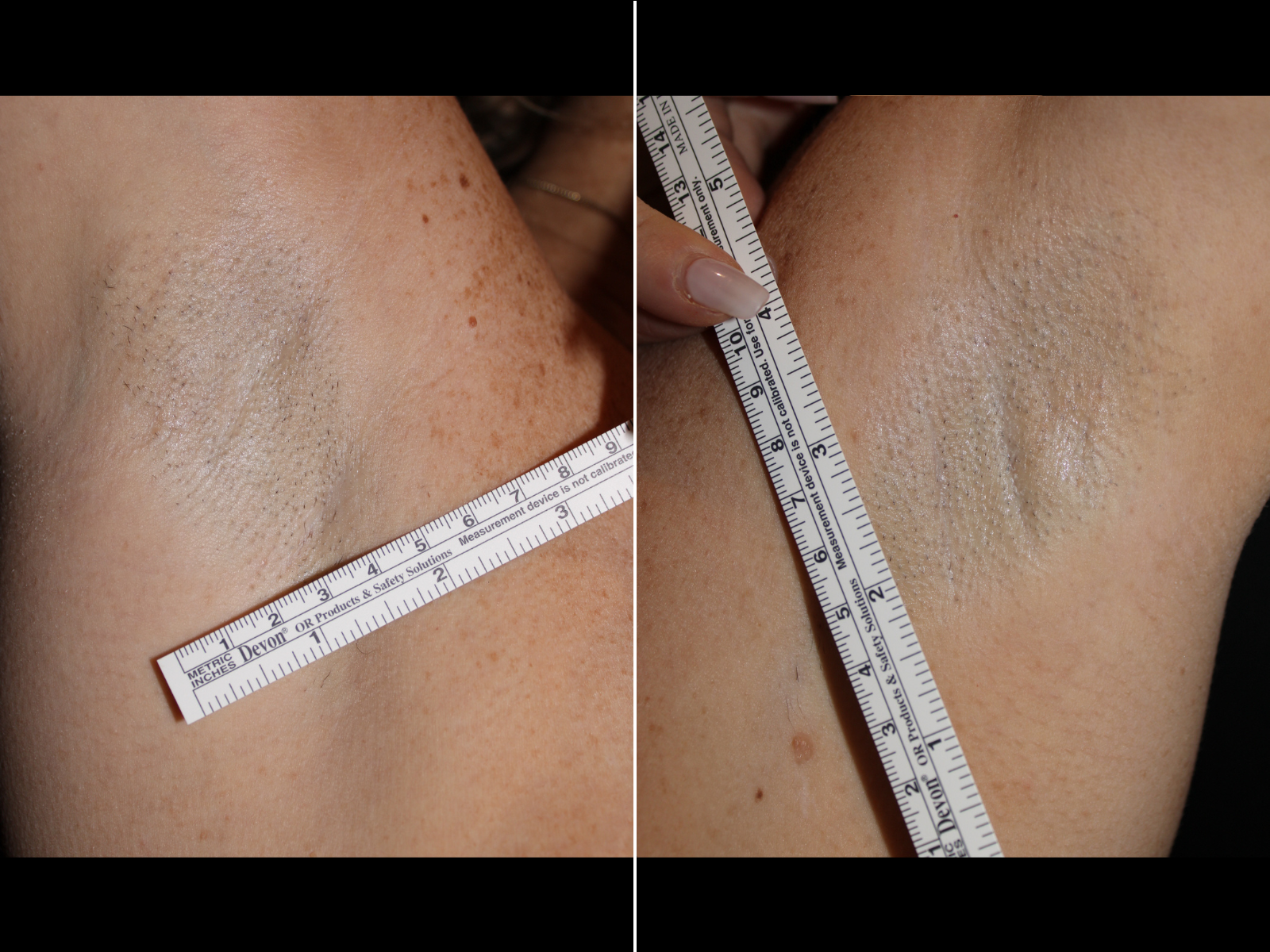 breast-augmentation-scar-before-and-after-dr-soler-baillo-coral-gables-01